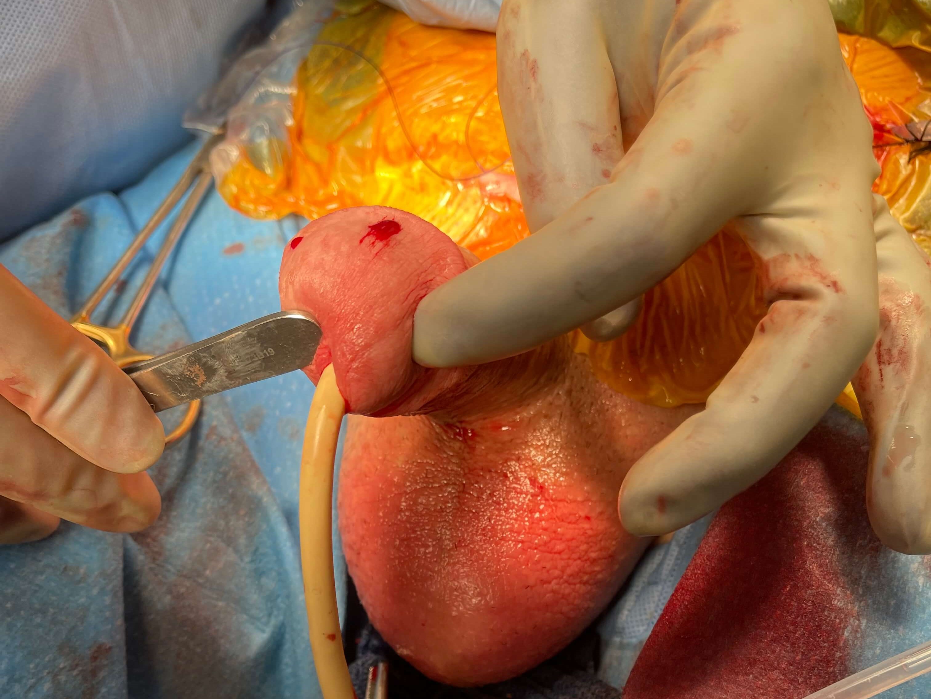 Penile Implant Revision Surgery Photo 3 Penile Implant Revision Surgery Photo 3