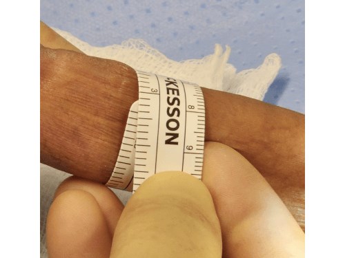 Penile Girth Enhancement 90cc Before