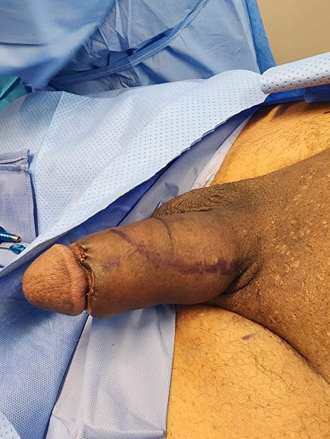 Penile Girth Enlargement 60cc After