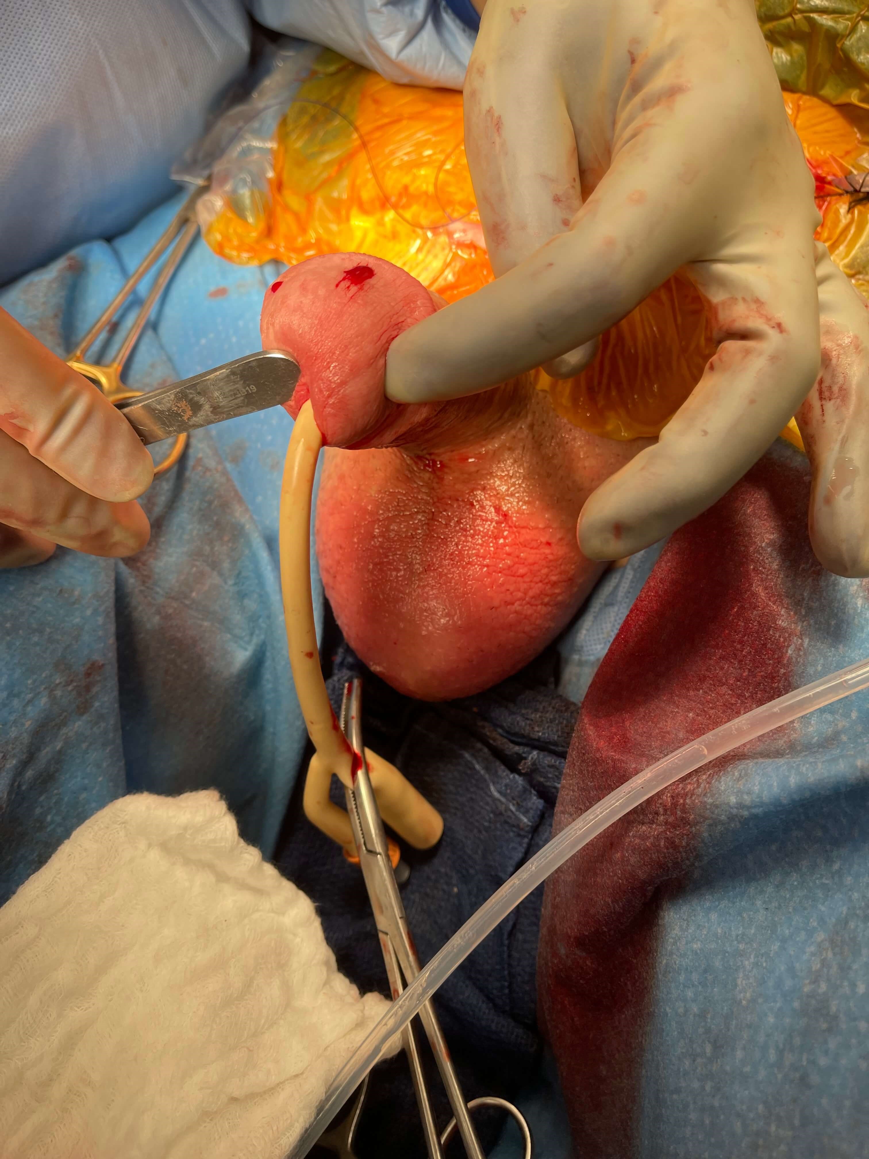 Penile Implant Revision Surgery Photo 3