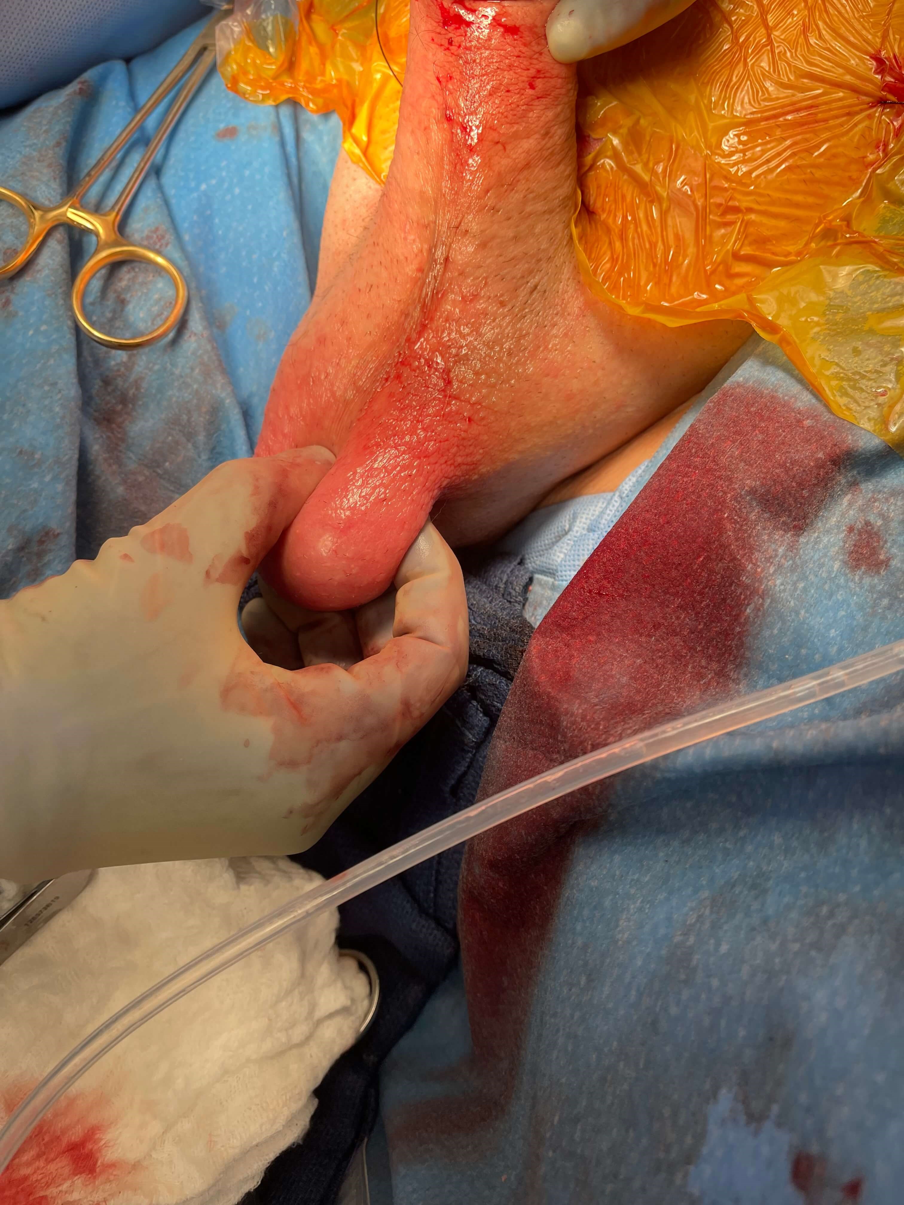 Penile Implant Revision Surgery Photo 4