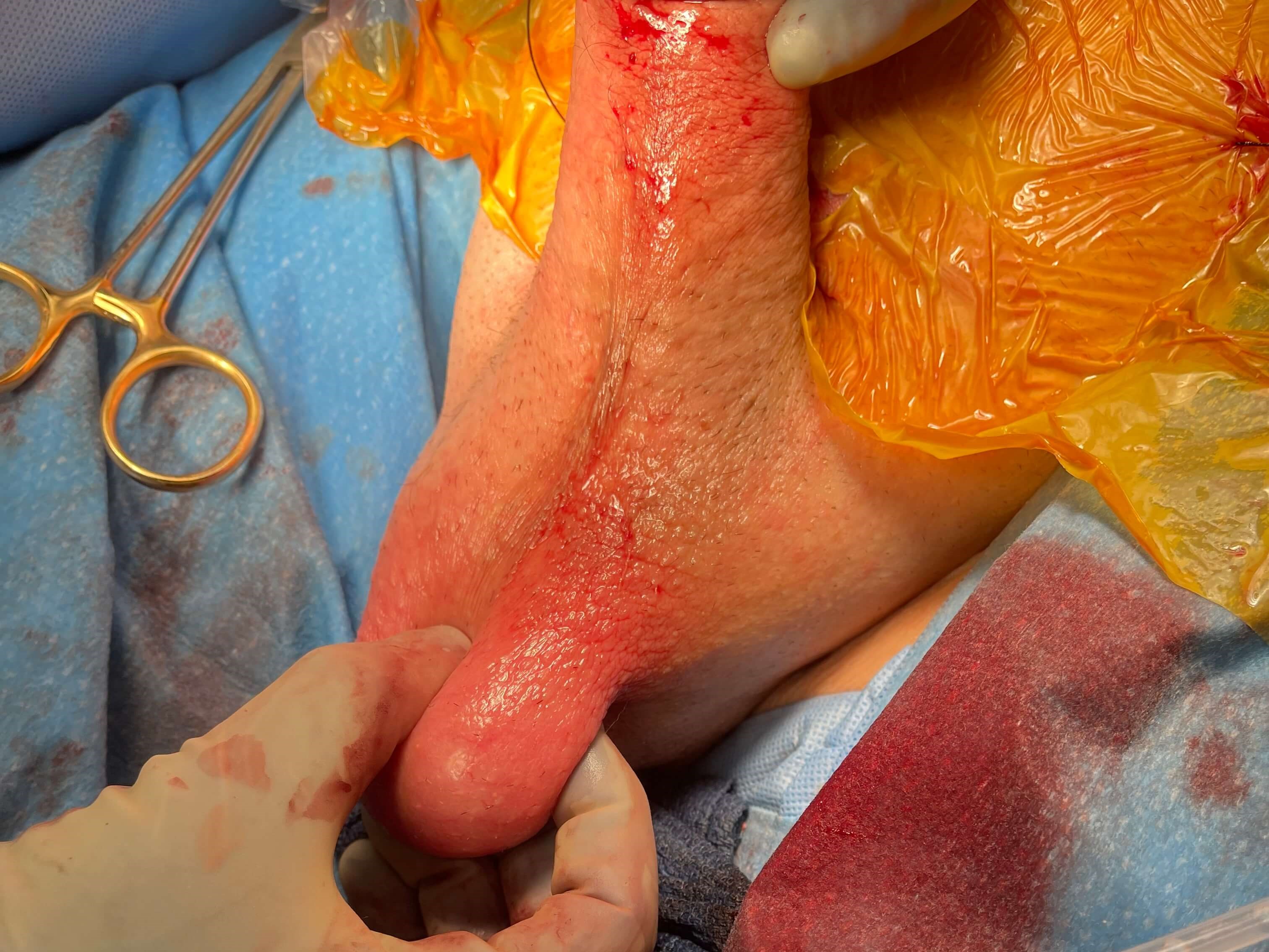 Penile Implant Revision Surgery Photo 4