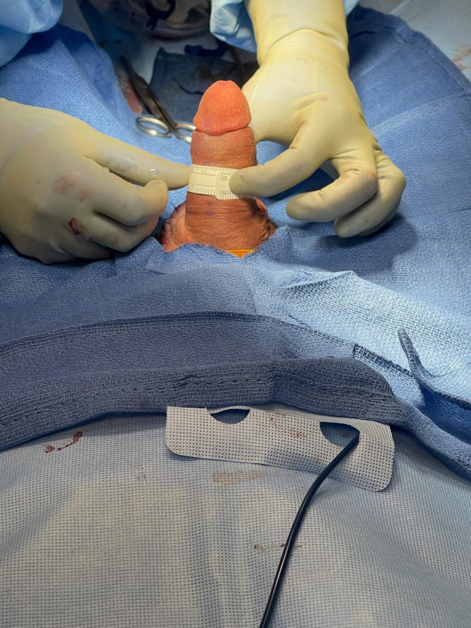 Penuma Penile Implant