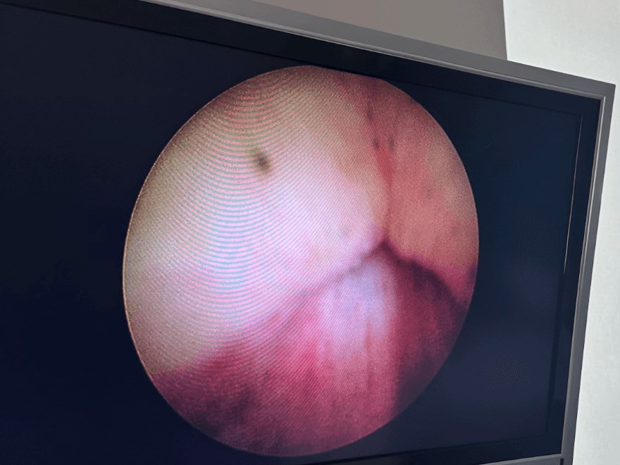 Enlarged prostate revision Before