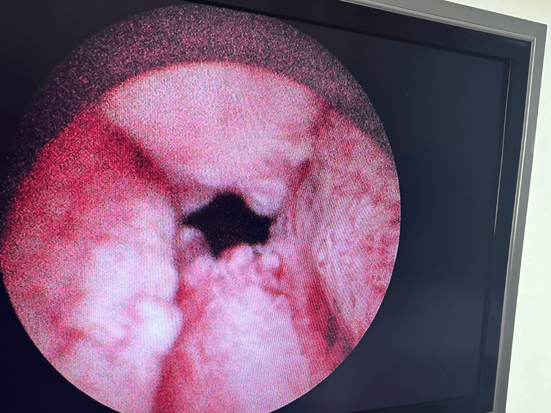 Enlarged prostate revision After