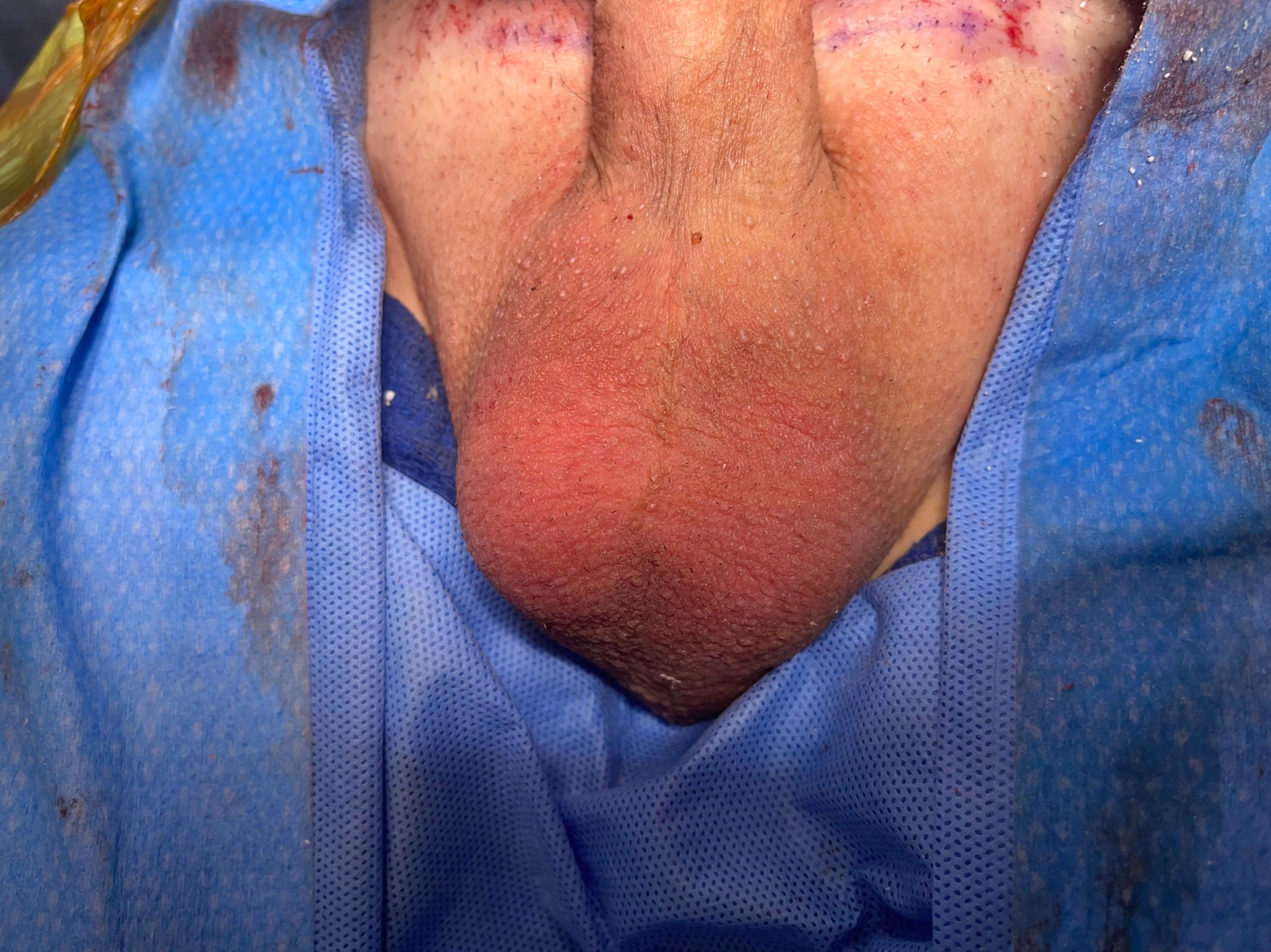 Torosa Testicle Prosthesis After