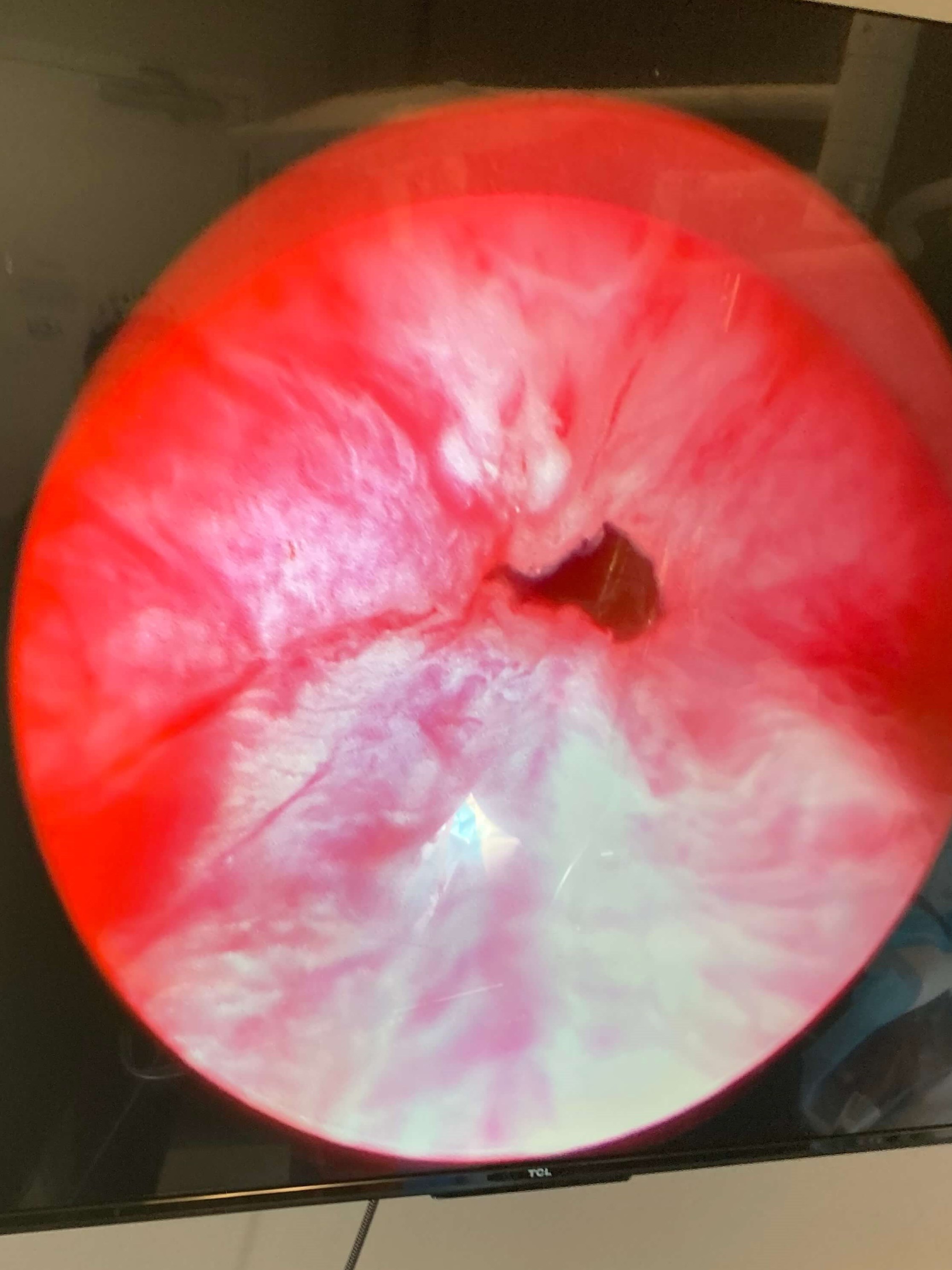 UroLift Atlanta, GA After UroLift