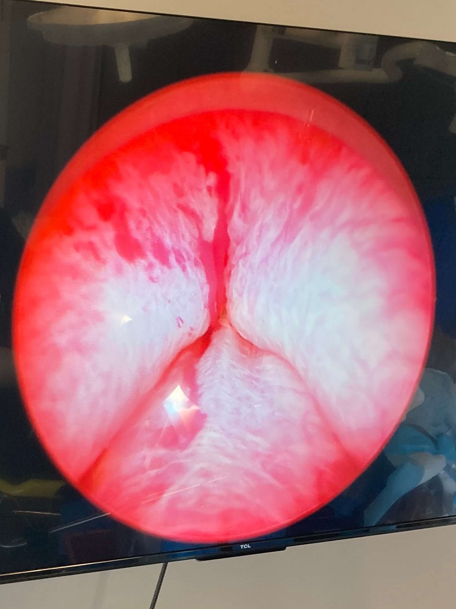 UroLift Atlanta, GA Before UroLift