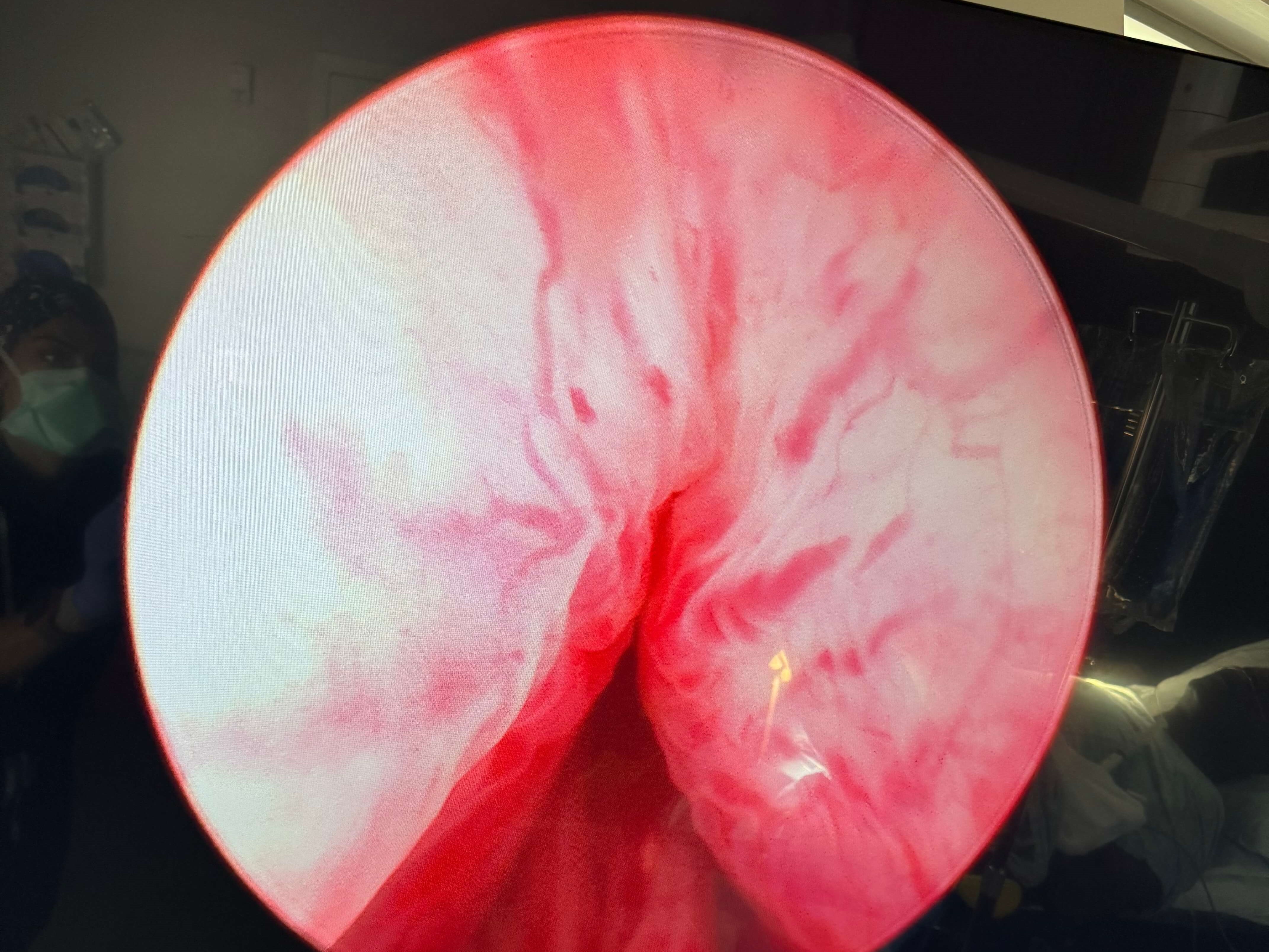 UroLift Atlanta, GA Before