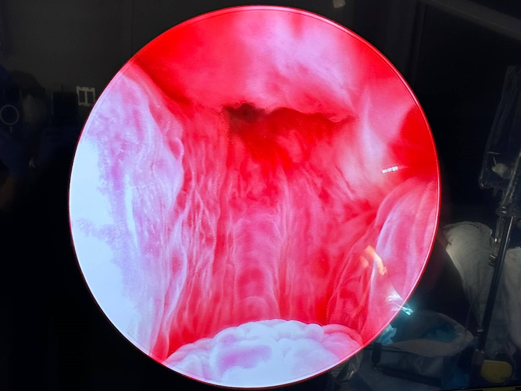 UroLift Atlanta, GA After