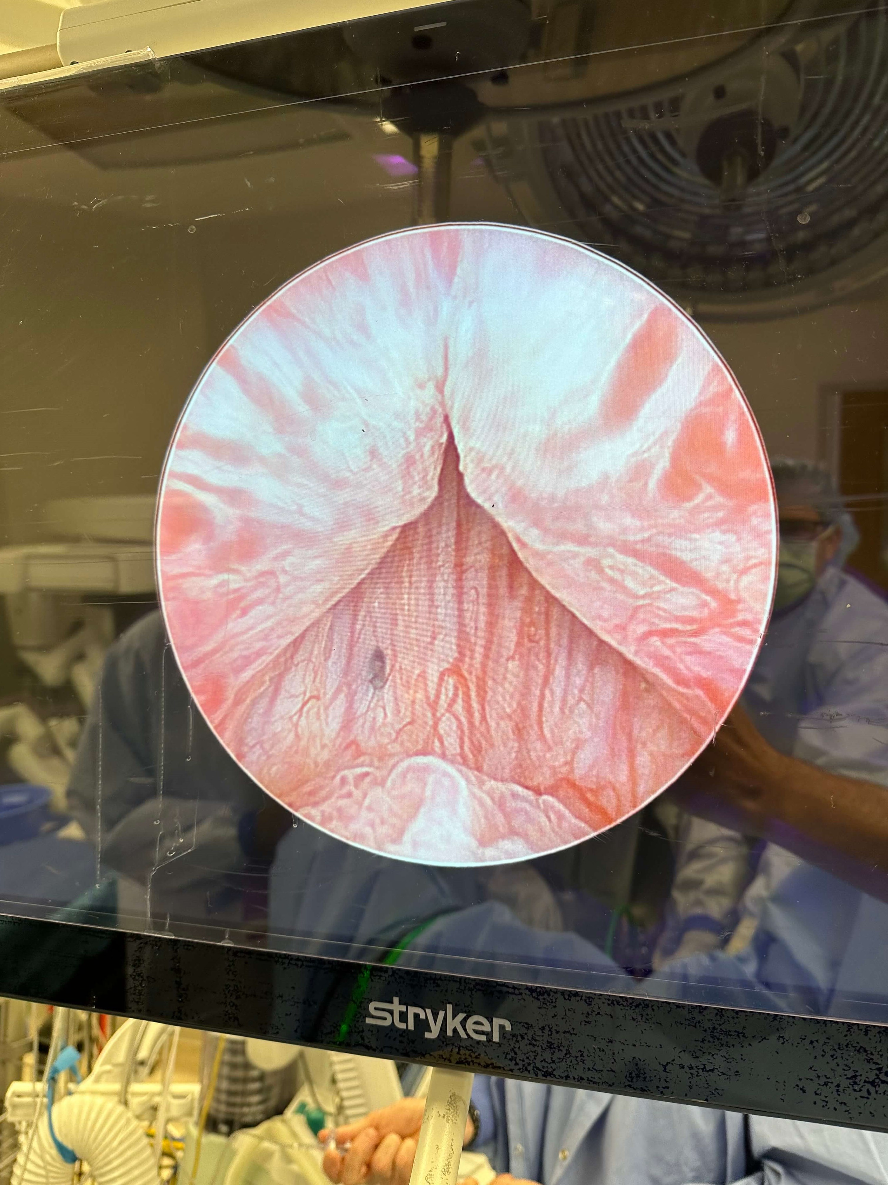 Urolift with 39g prostate 