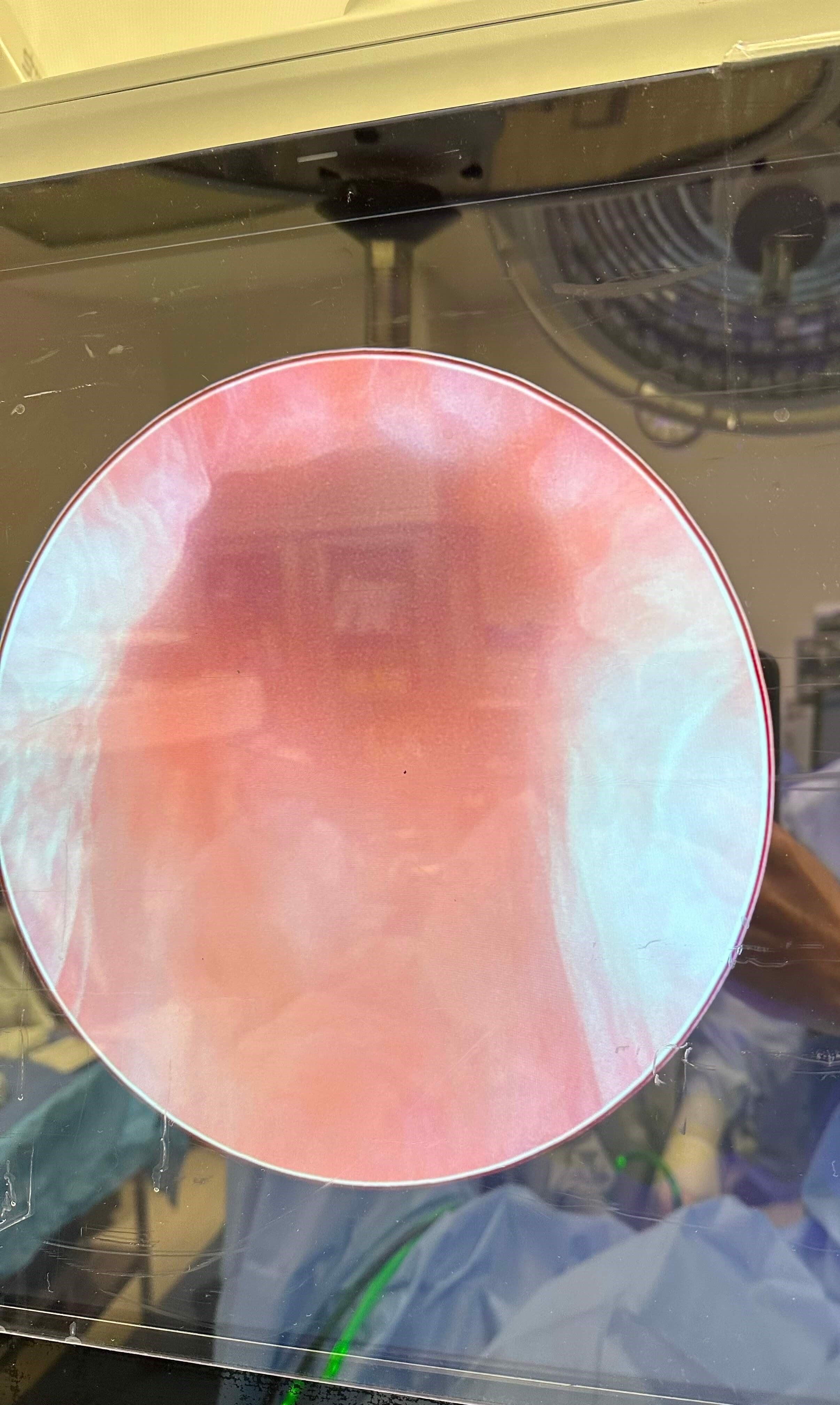 Urolift with 39g prostate 