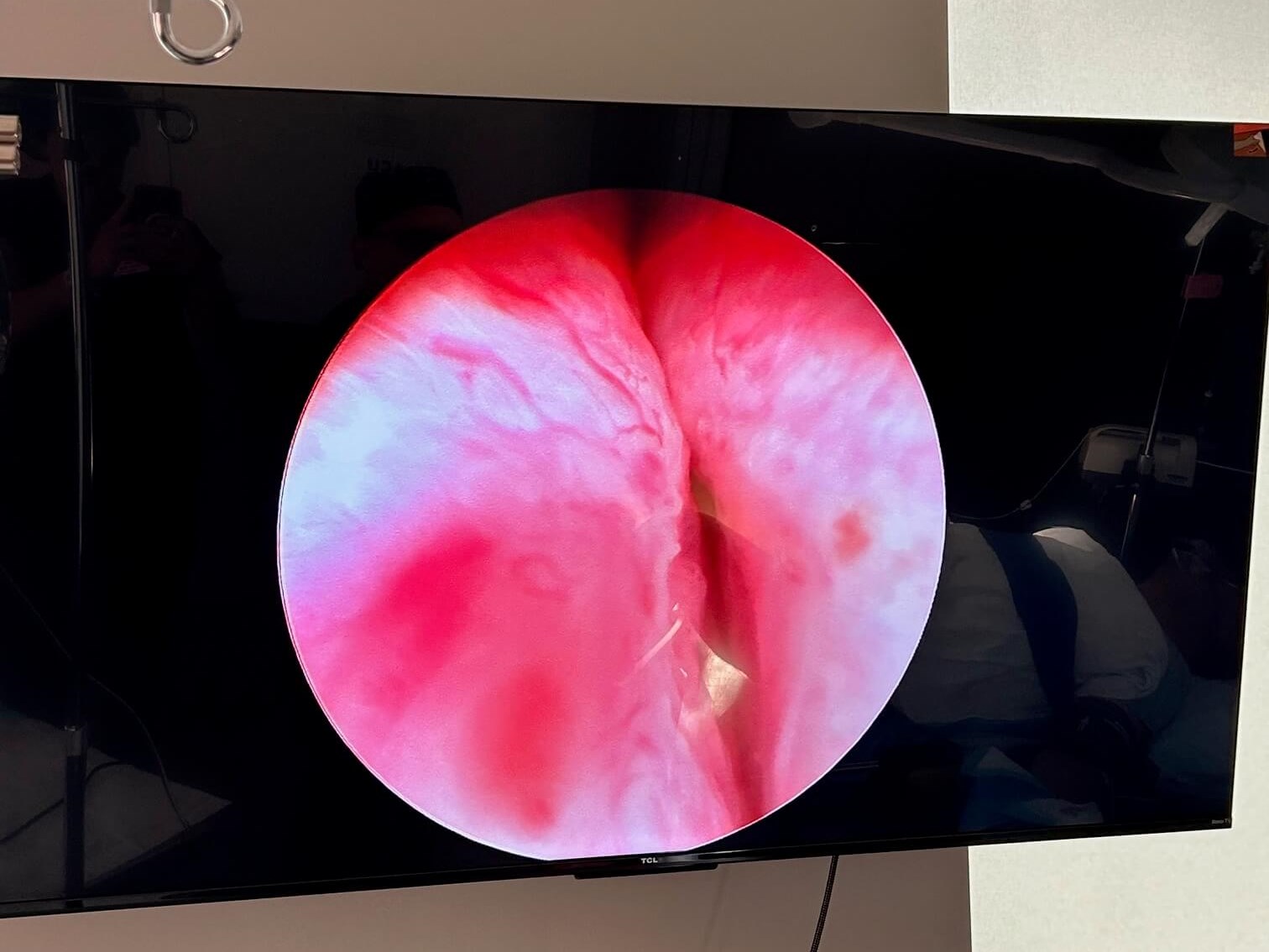 Urolift with 62 gram prostate Before