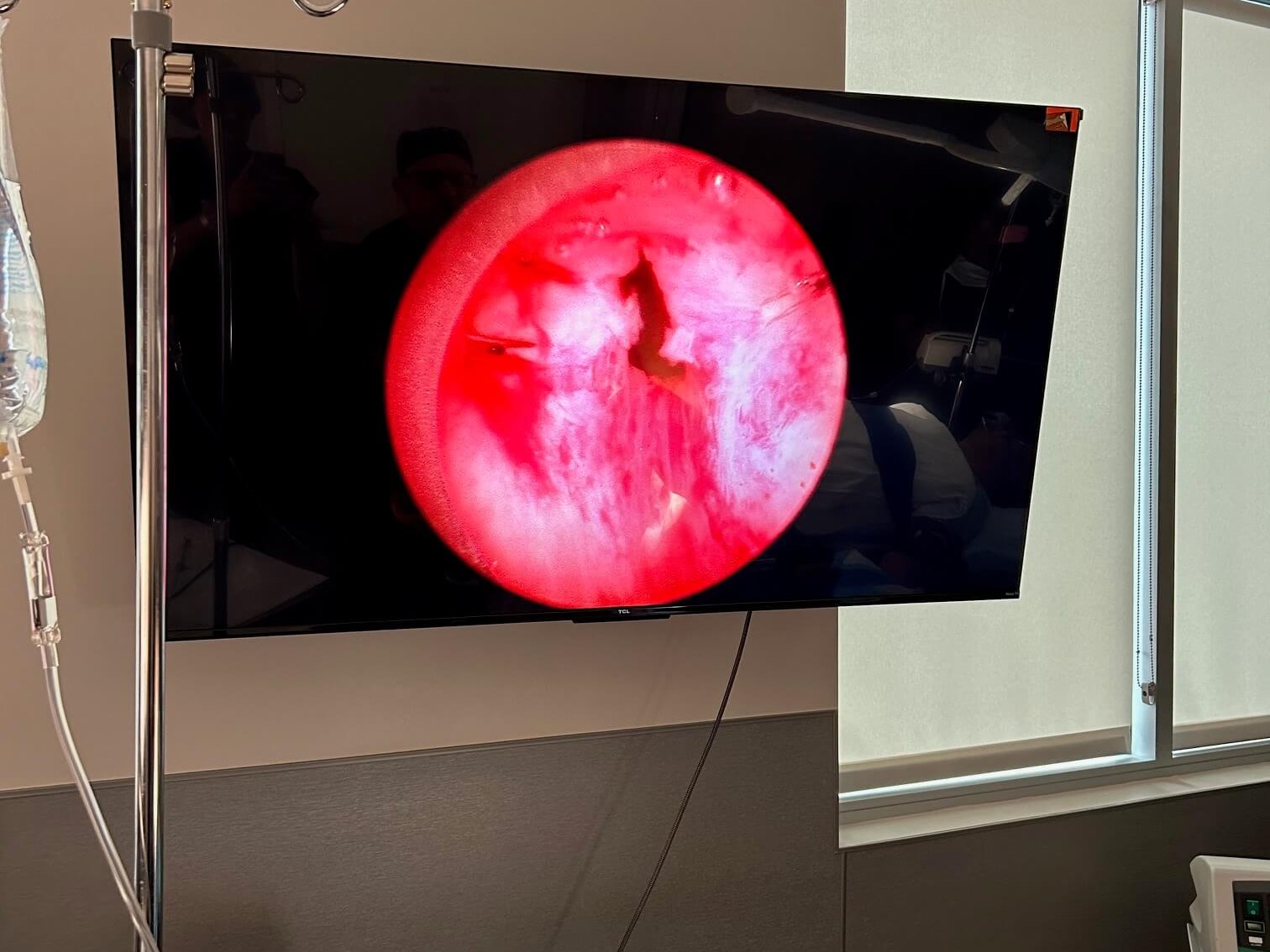 Urolift with 62 gram prostate After