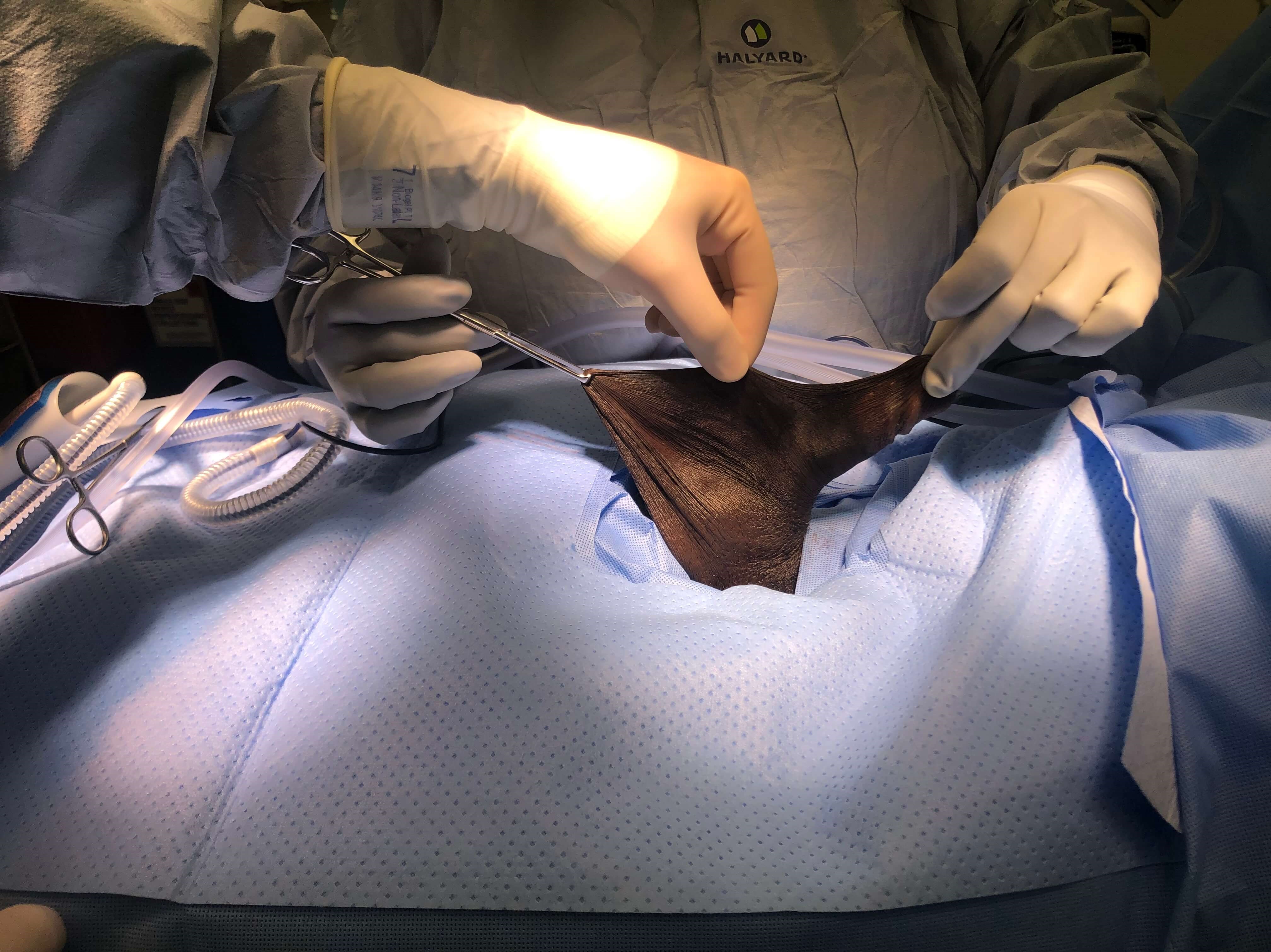 Before & After - Scrotum Lift After