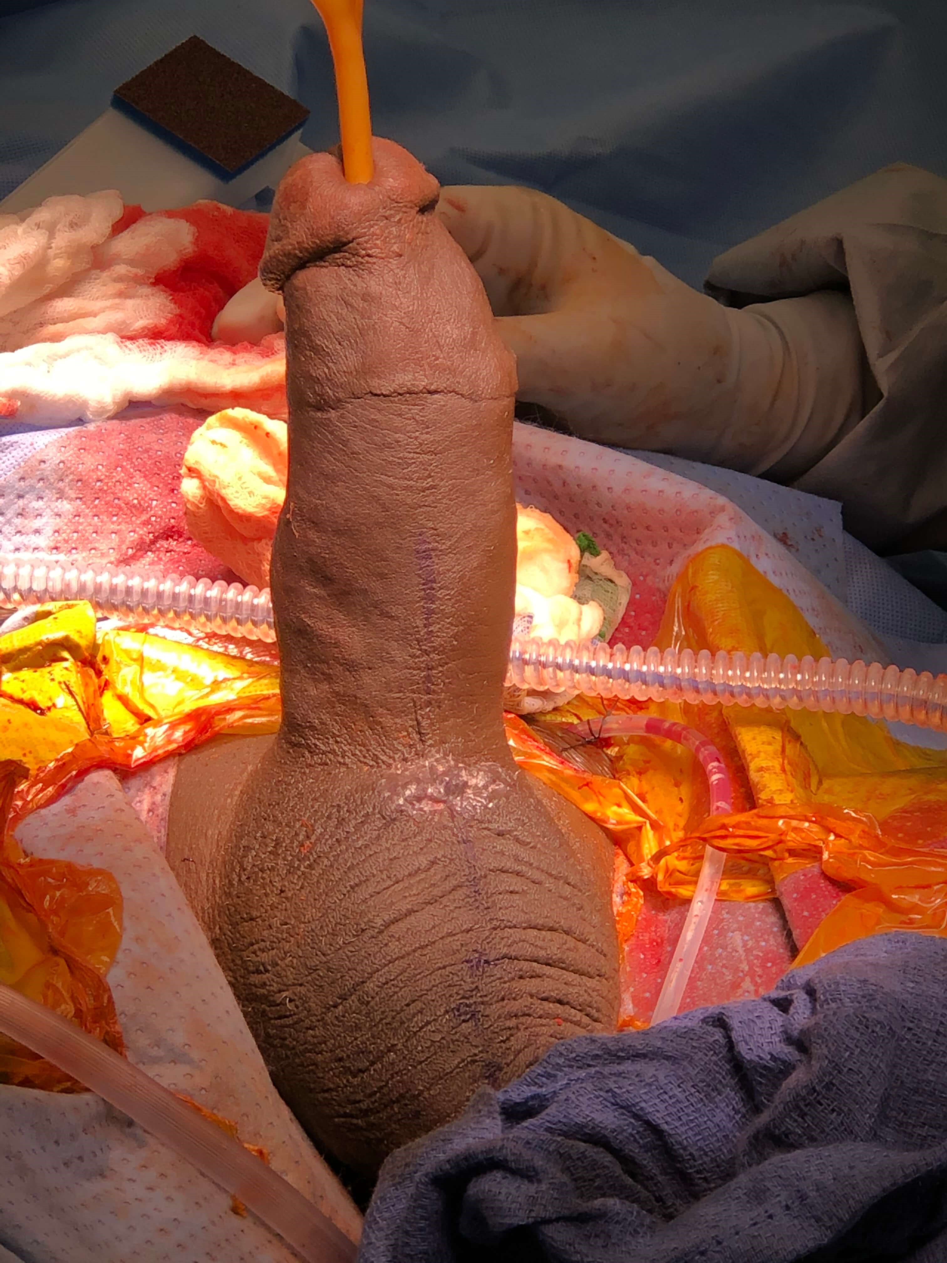 Penile Implant Revision Surgery Photo 3