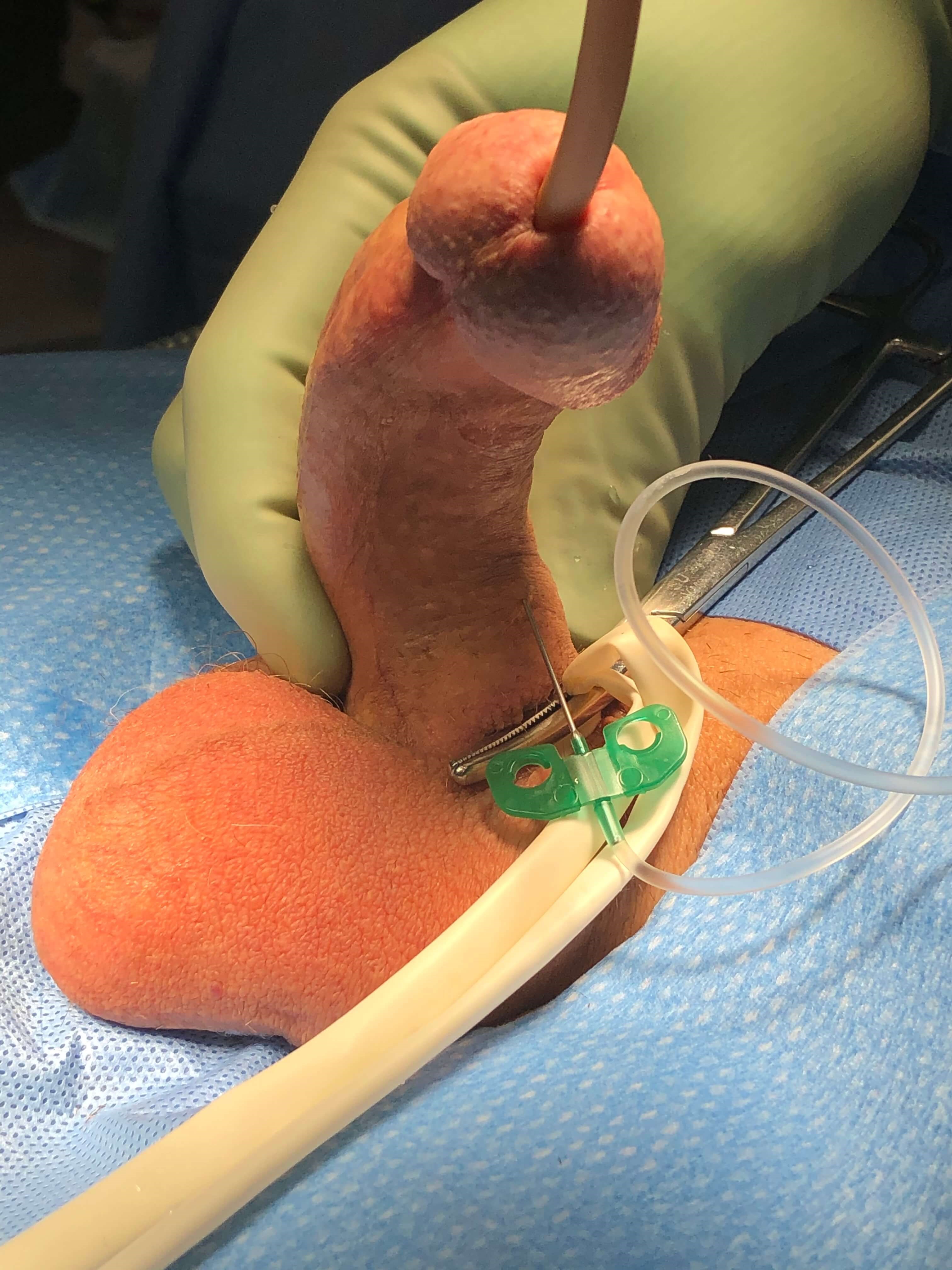 Peyronie's Disease Photos Surgical Photo 1