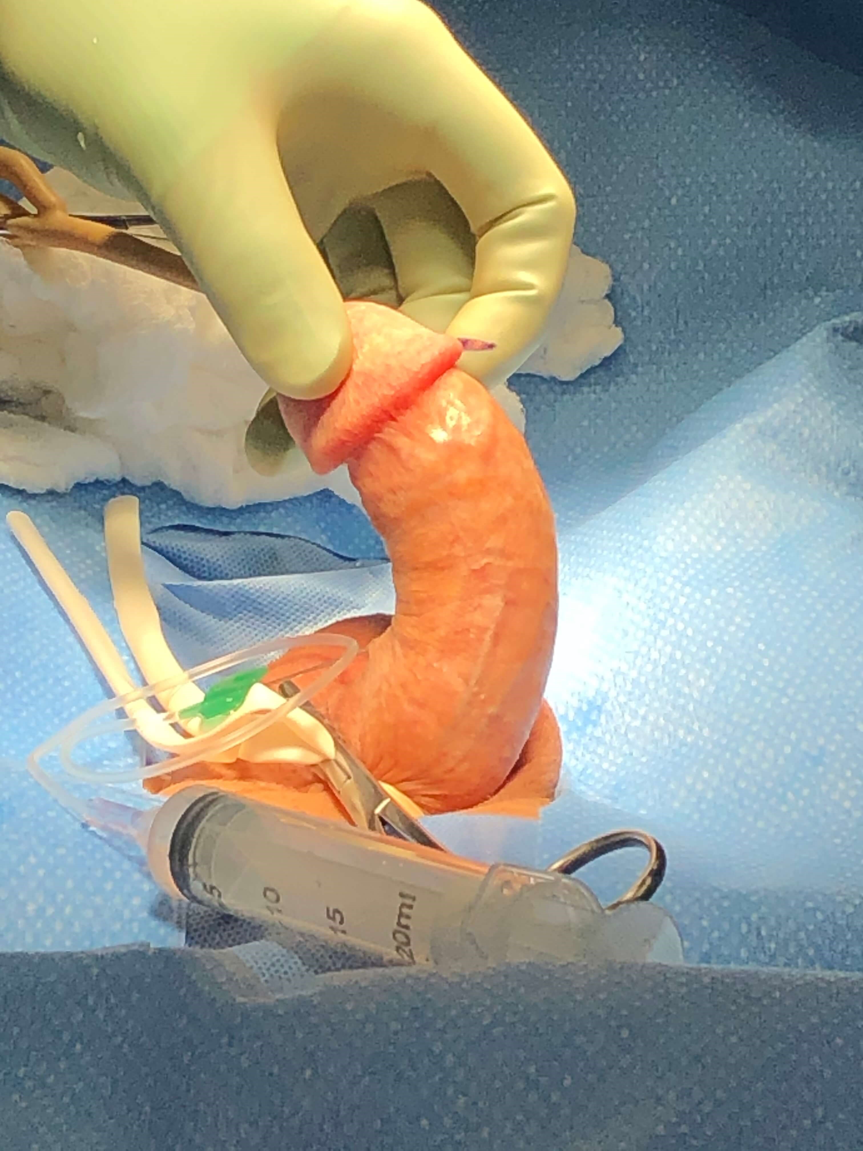 Peyronie's Disease Photos Surgical Photo 2