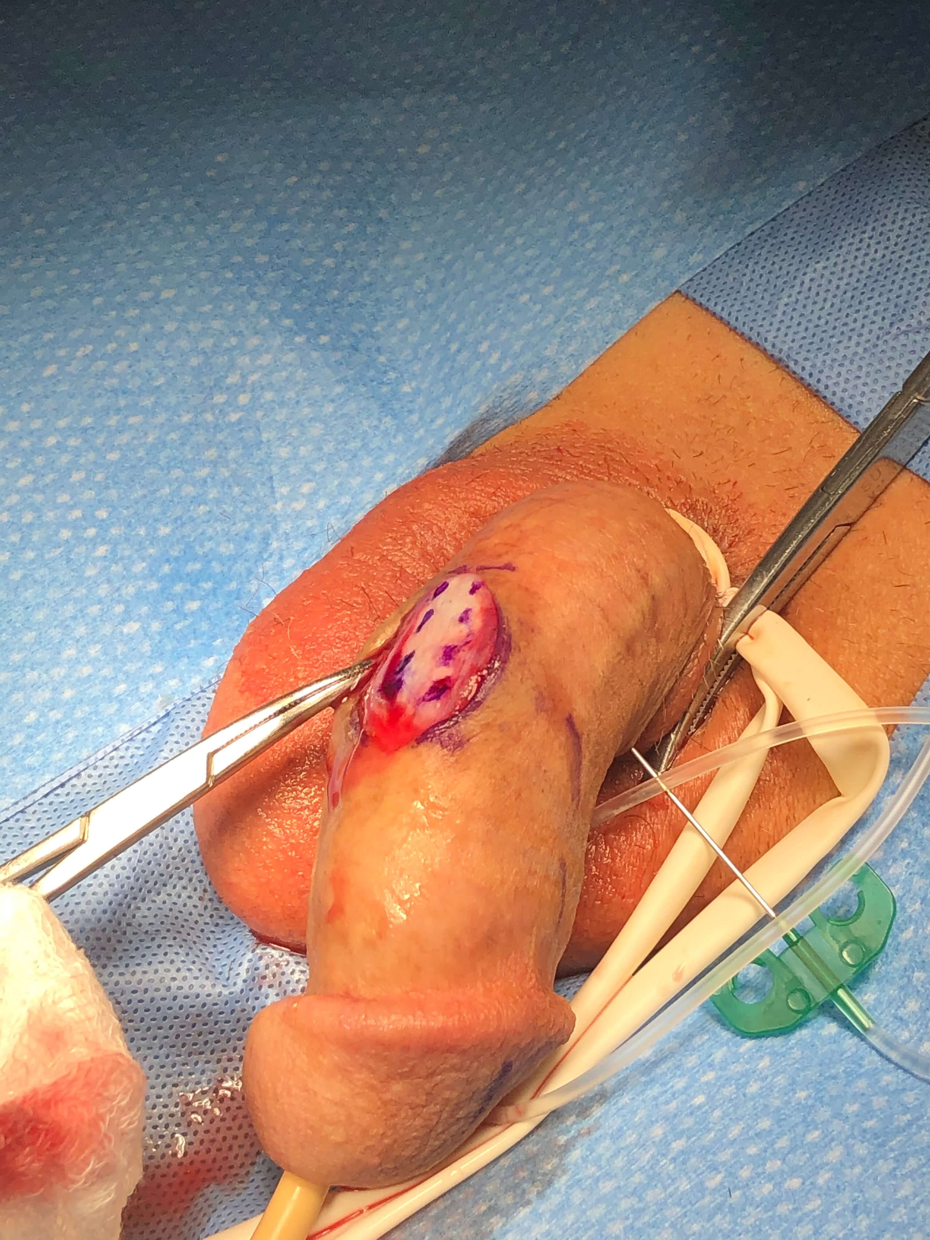 Peyronie's Disease Photos Surgical Photo 3