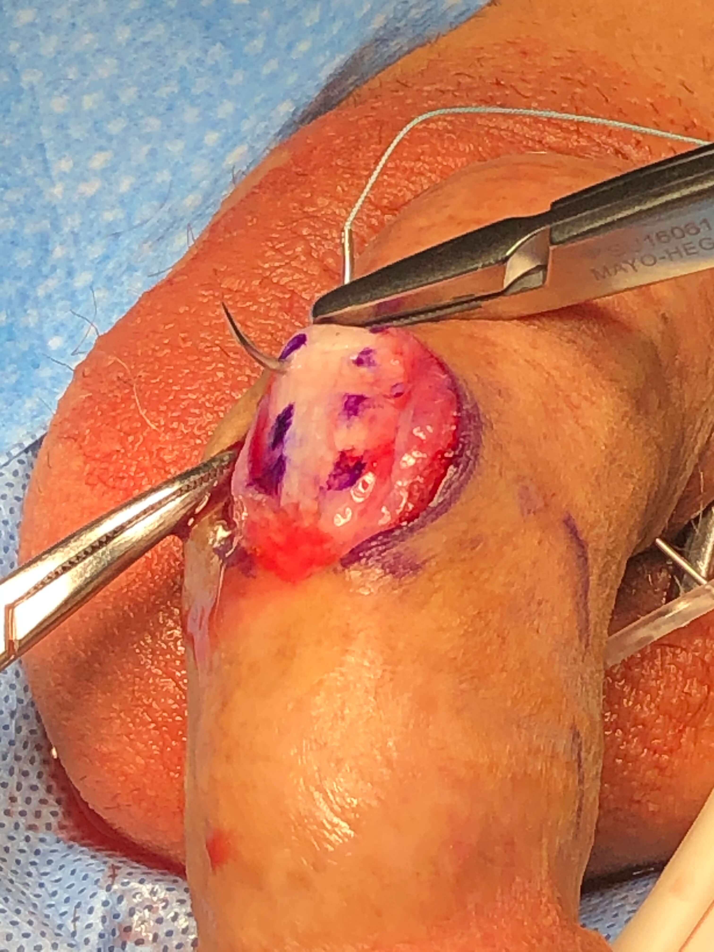 Peyronie's Disease Photos Surgical Photo 4