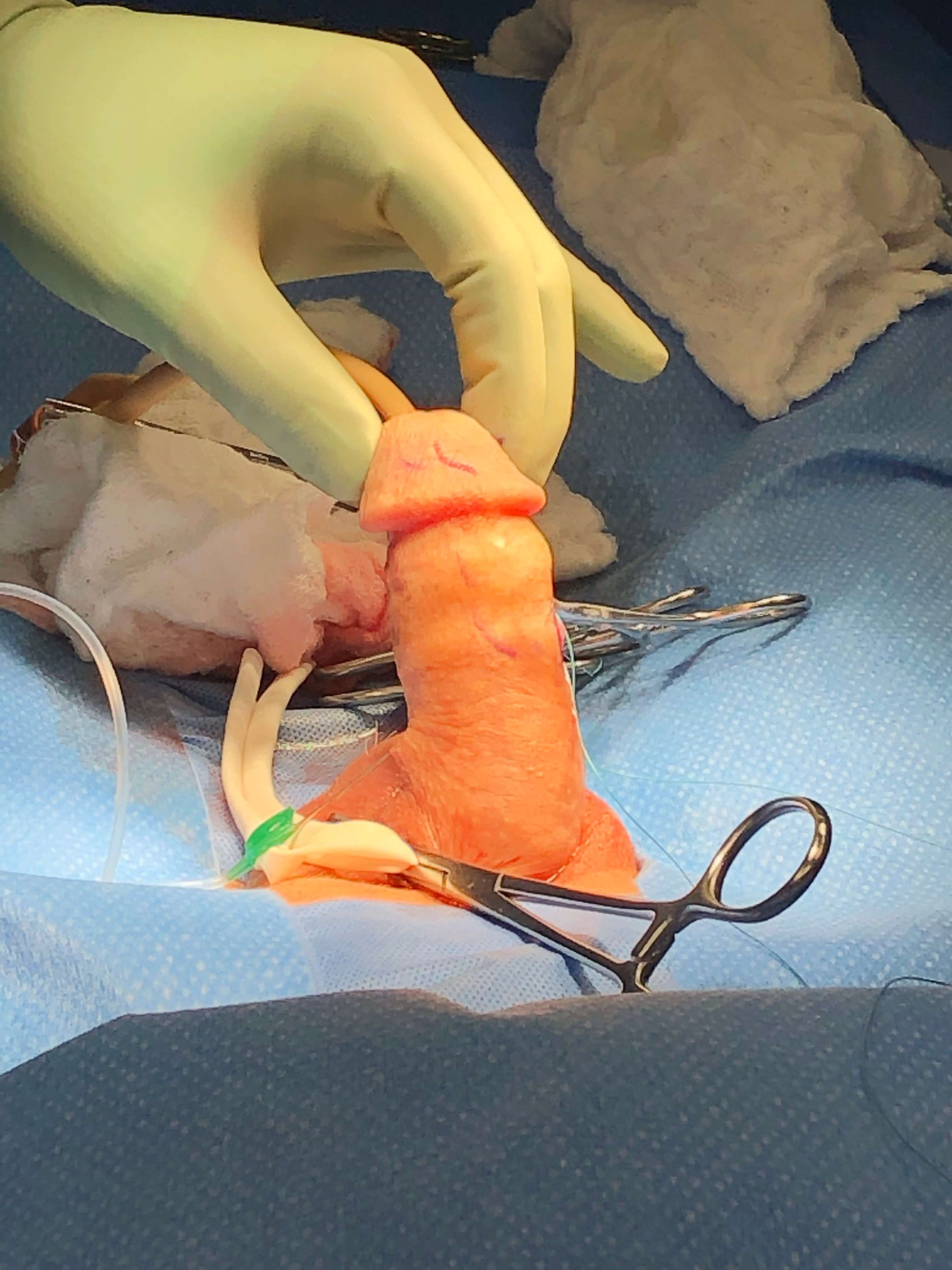 Peyronie's Disease Photos Surgical Photo 5