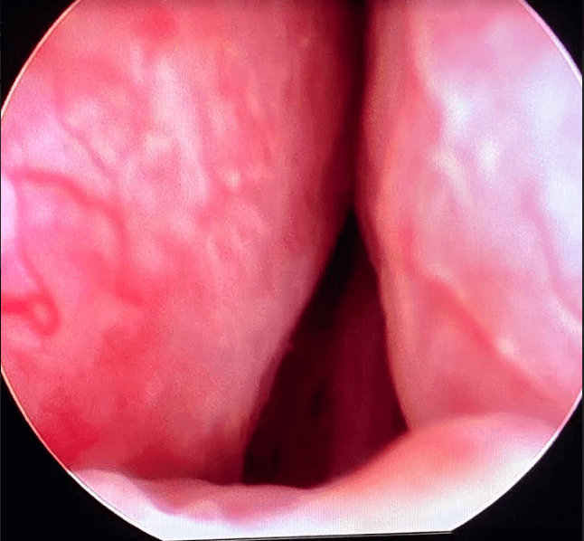 UroLift Before UroLift