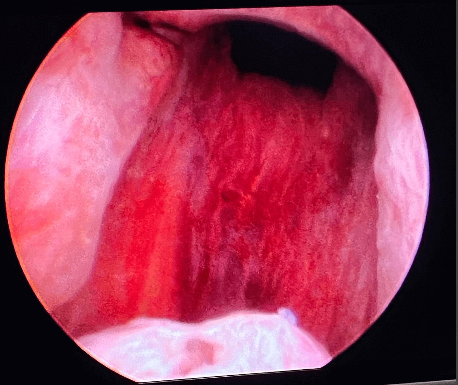 UroLift After UroLift