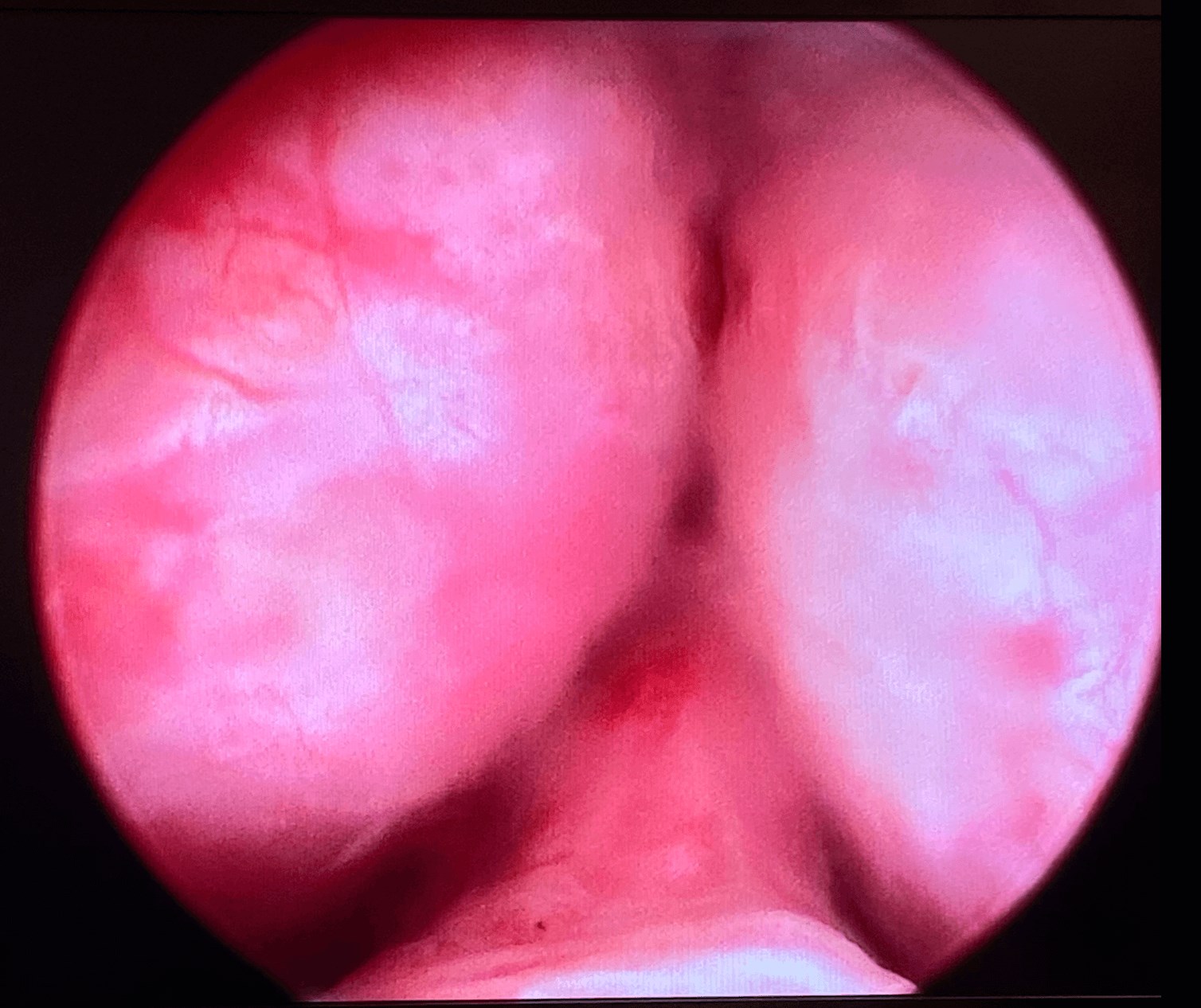 UroLift Before UroLift