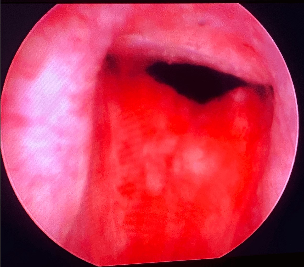 UroLift After UroLift