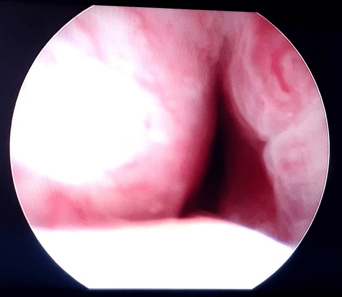 UroLift Before and After Before UroLift