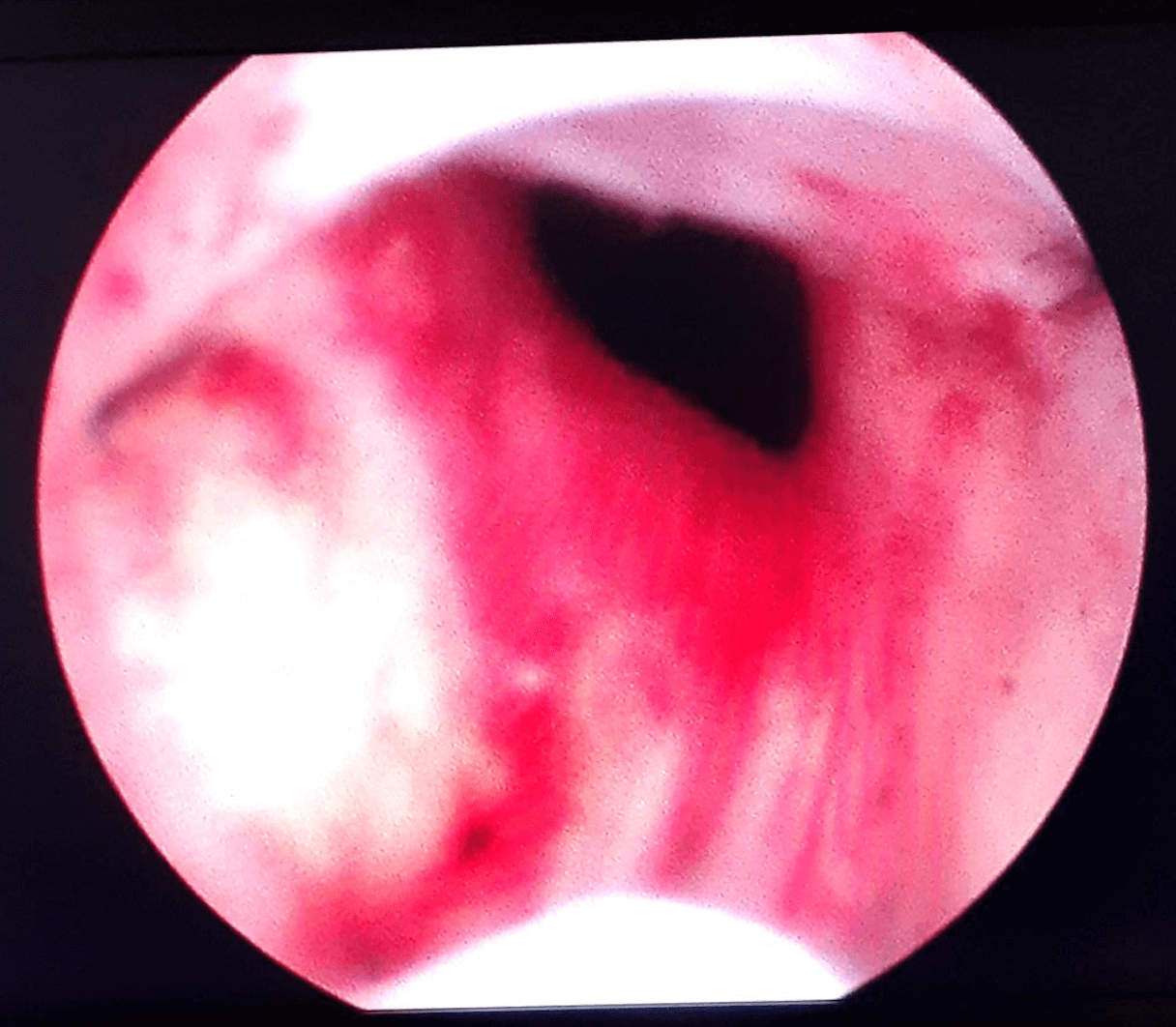 UroLift Before and After After UroLift