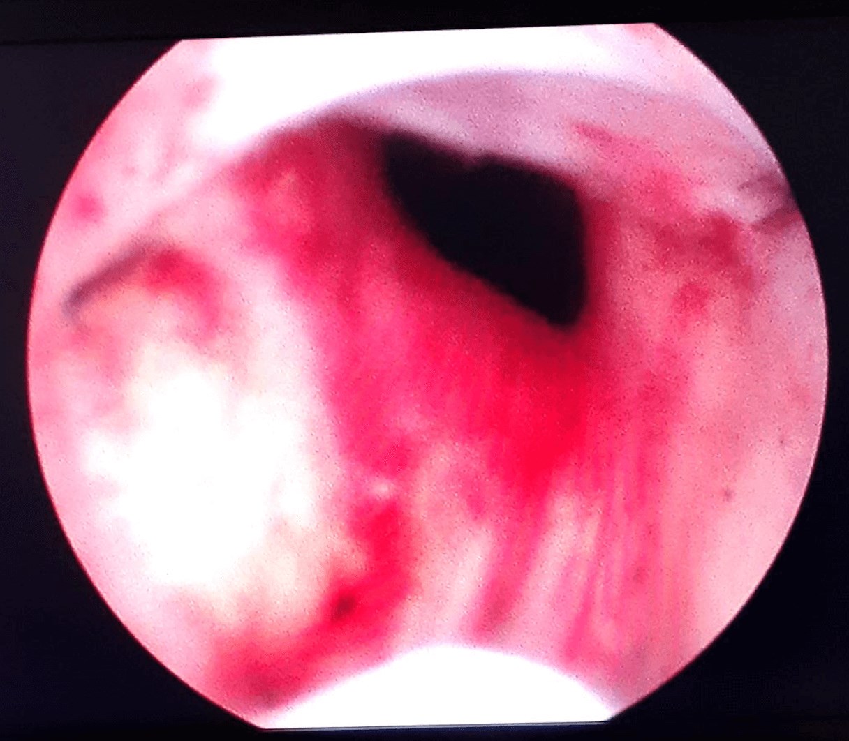 UroLift Before and After After UroLift