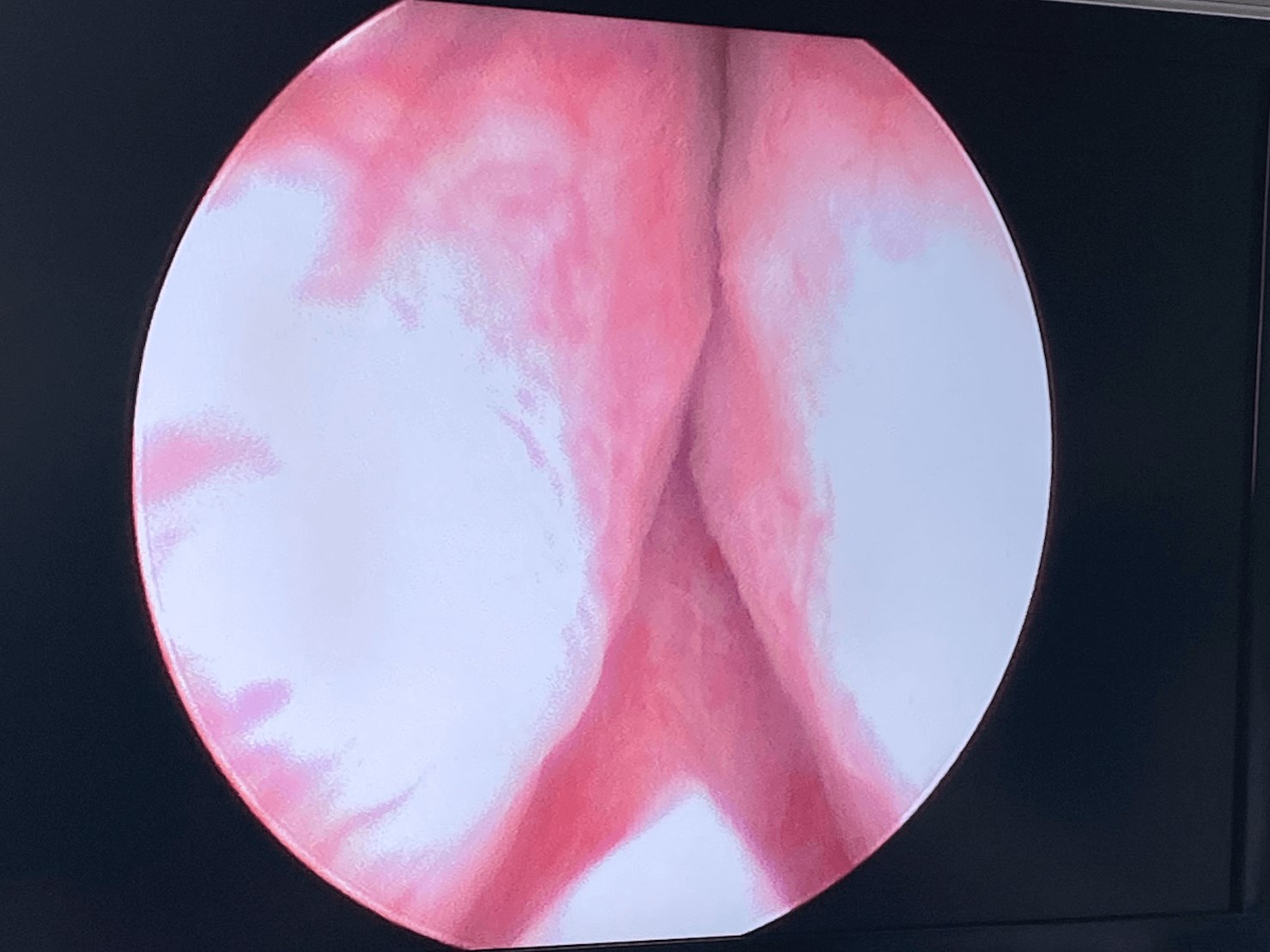 UroLift Before and After Before