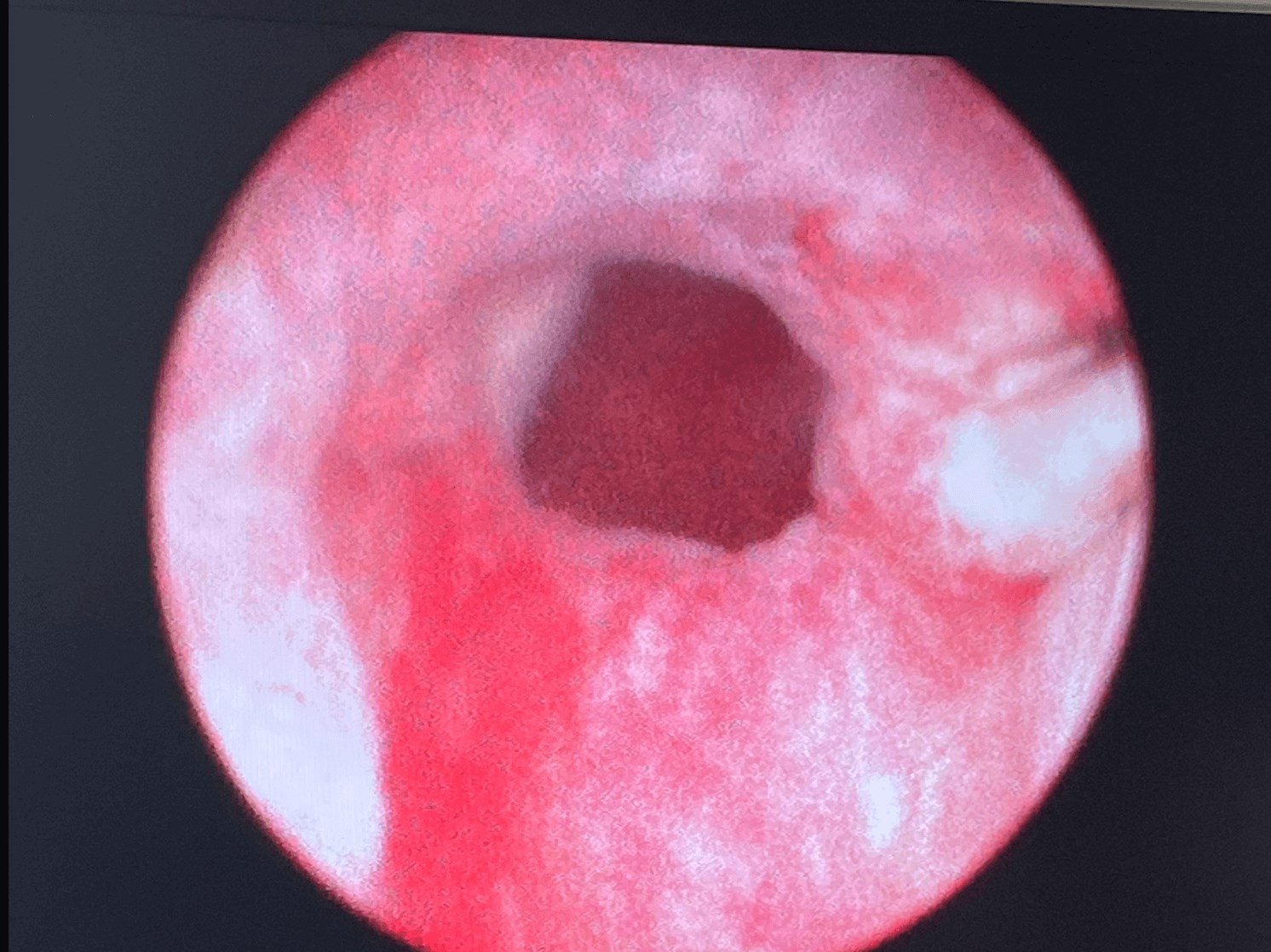 UroLift Before and After After