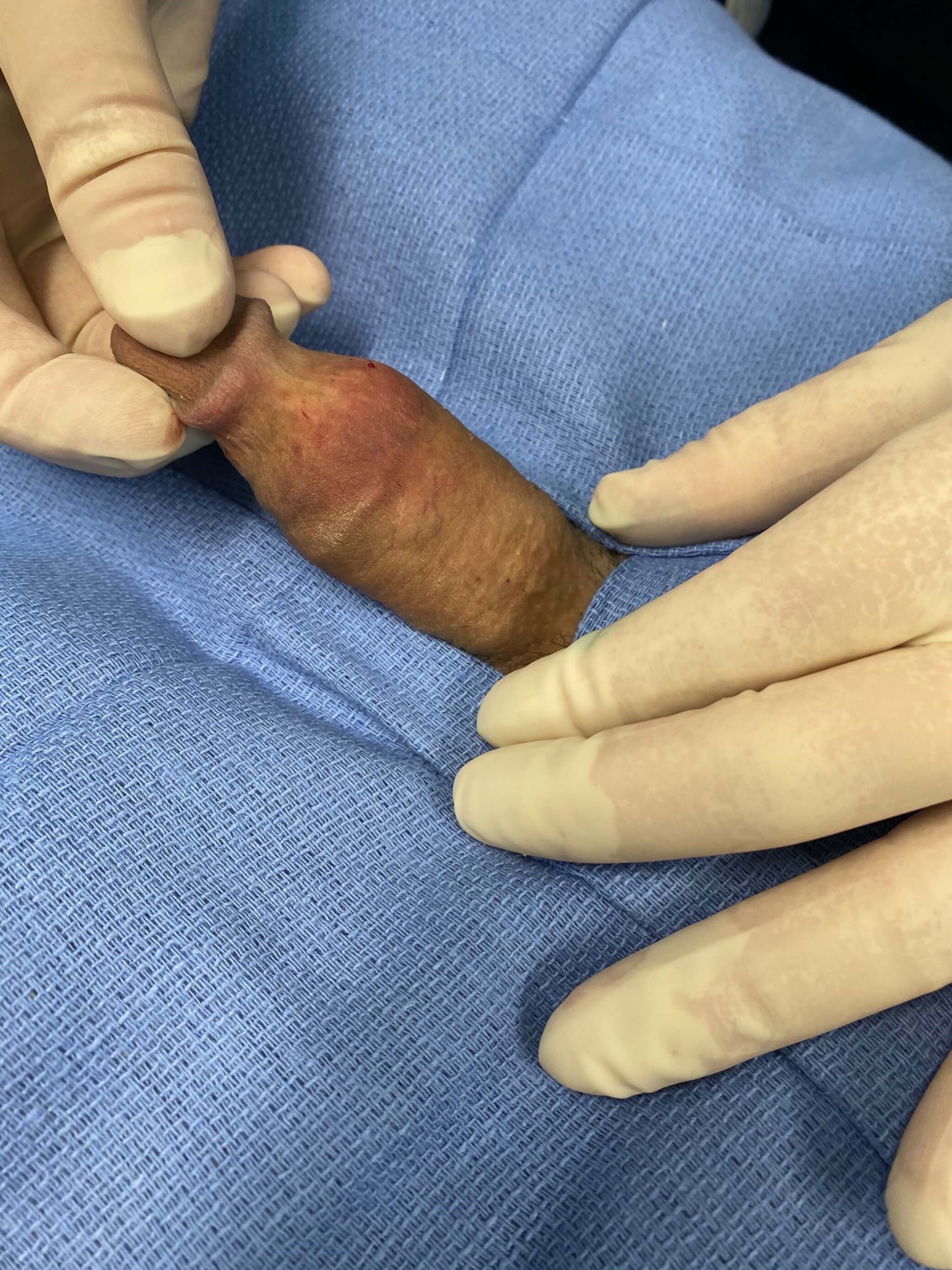 Before & After Penile Girth After