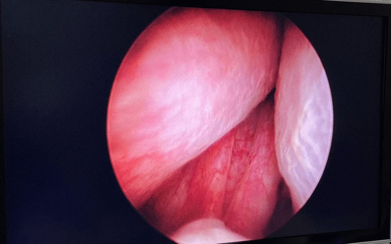 Before & After Urolift Before