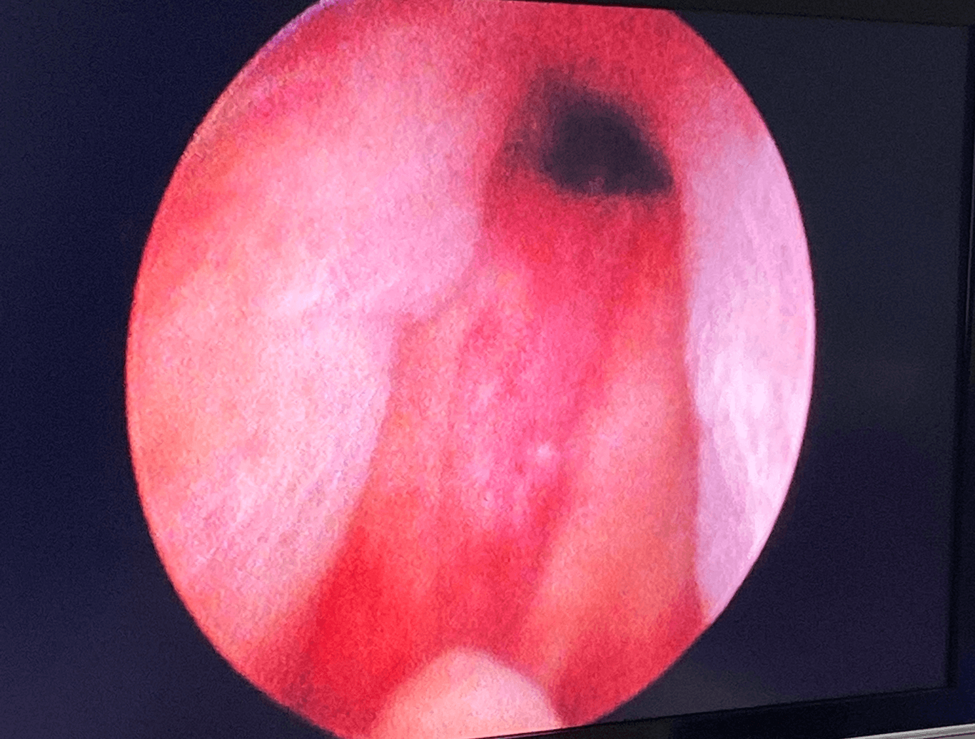 Before & After Urolift After