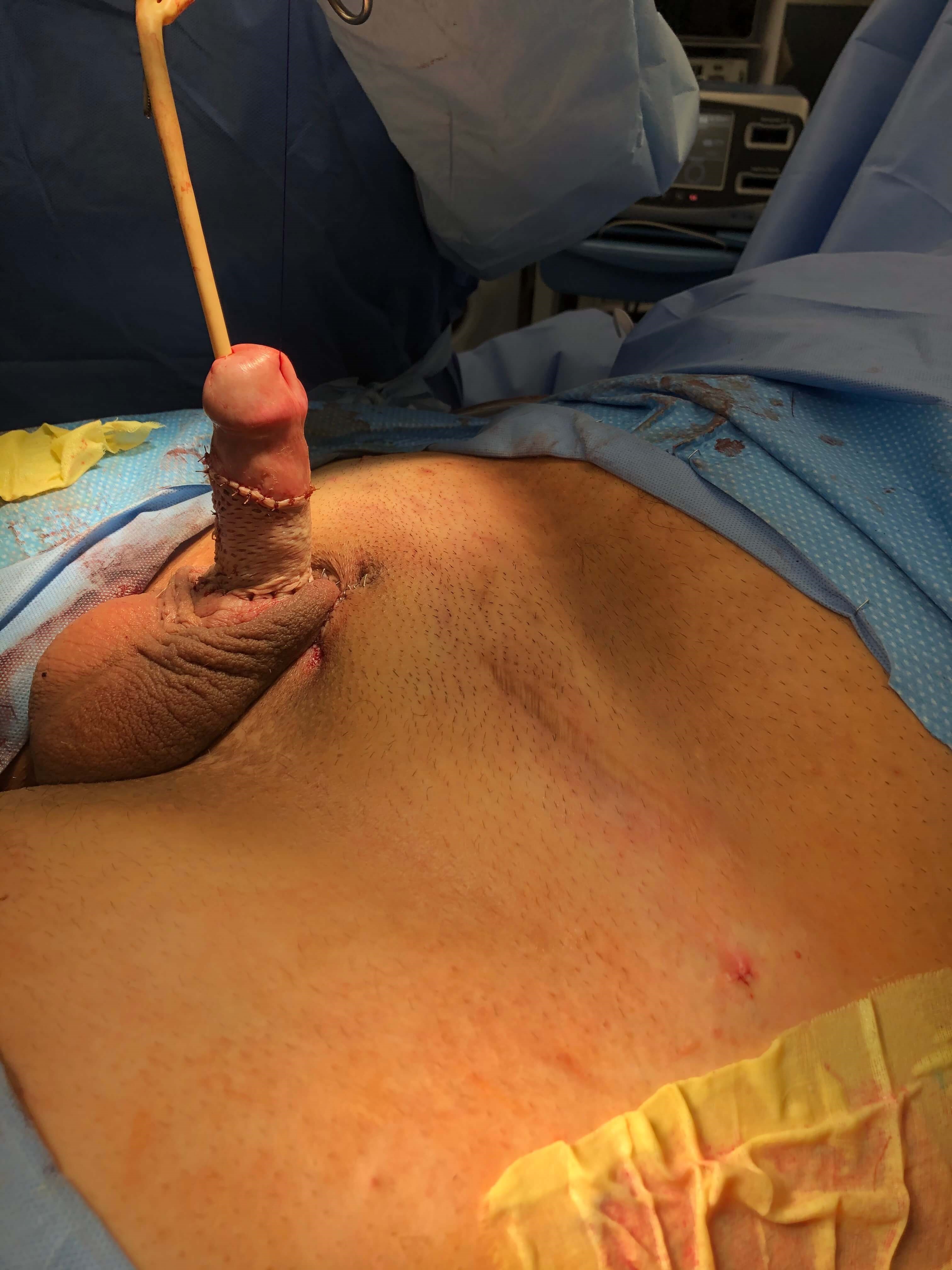 Buried Penis Repair - Atlanta After