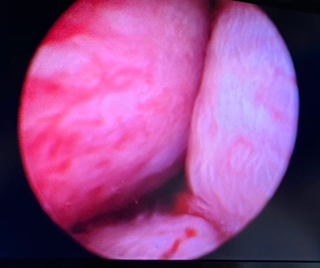 UroLift Atlanta, GA Before UroLift