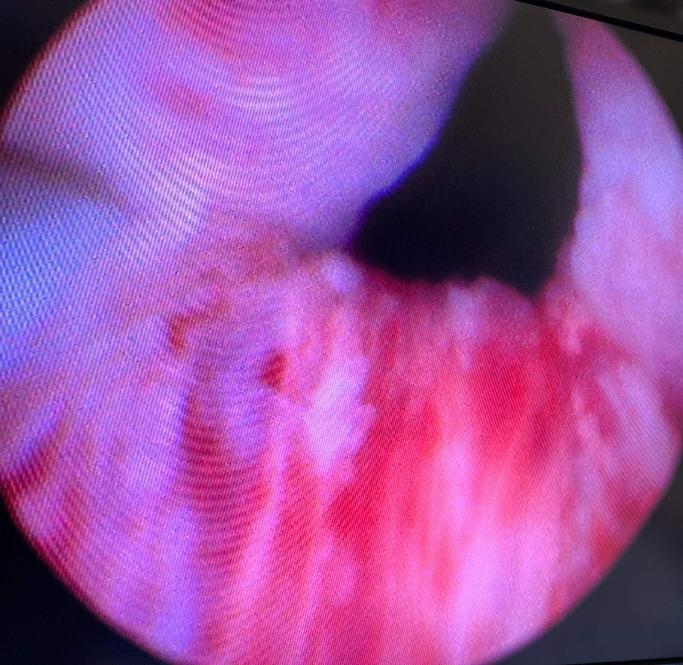 UroLift Atlanta, GA After UroLift