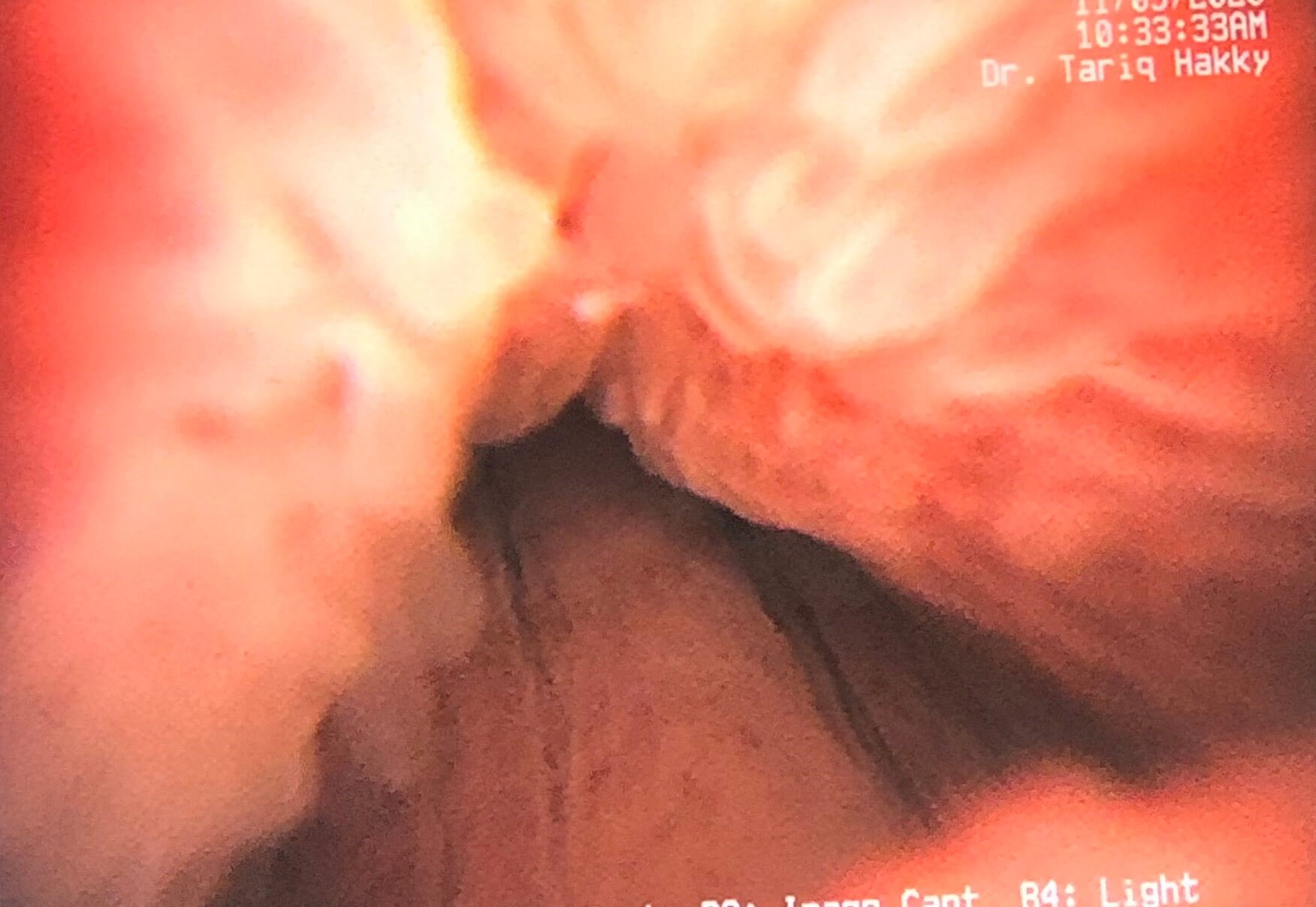 Prostatitis Altanta, GA Prostatitis mid urethra