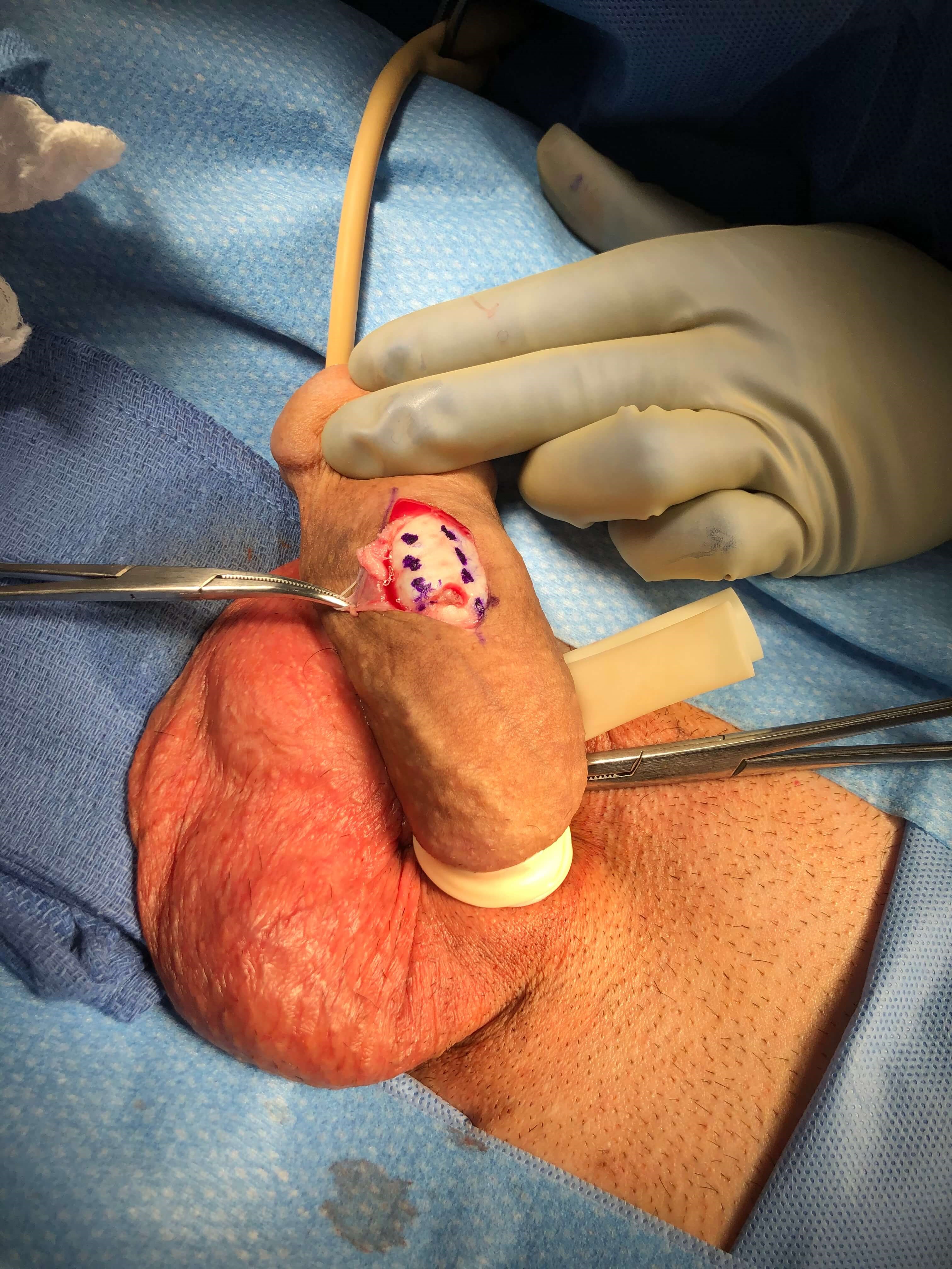 Before Dot Plication Technique Before