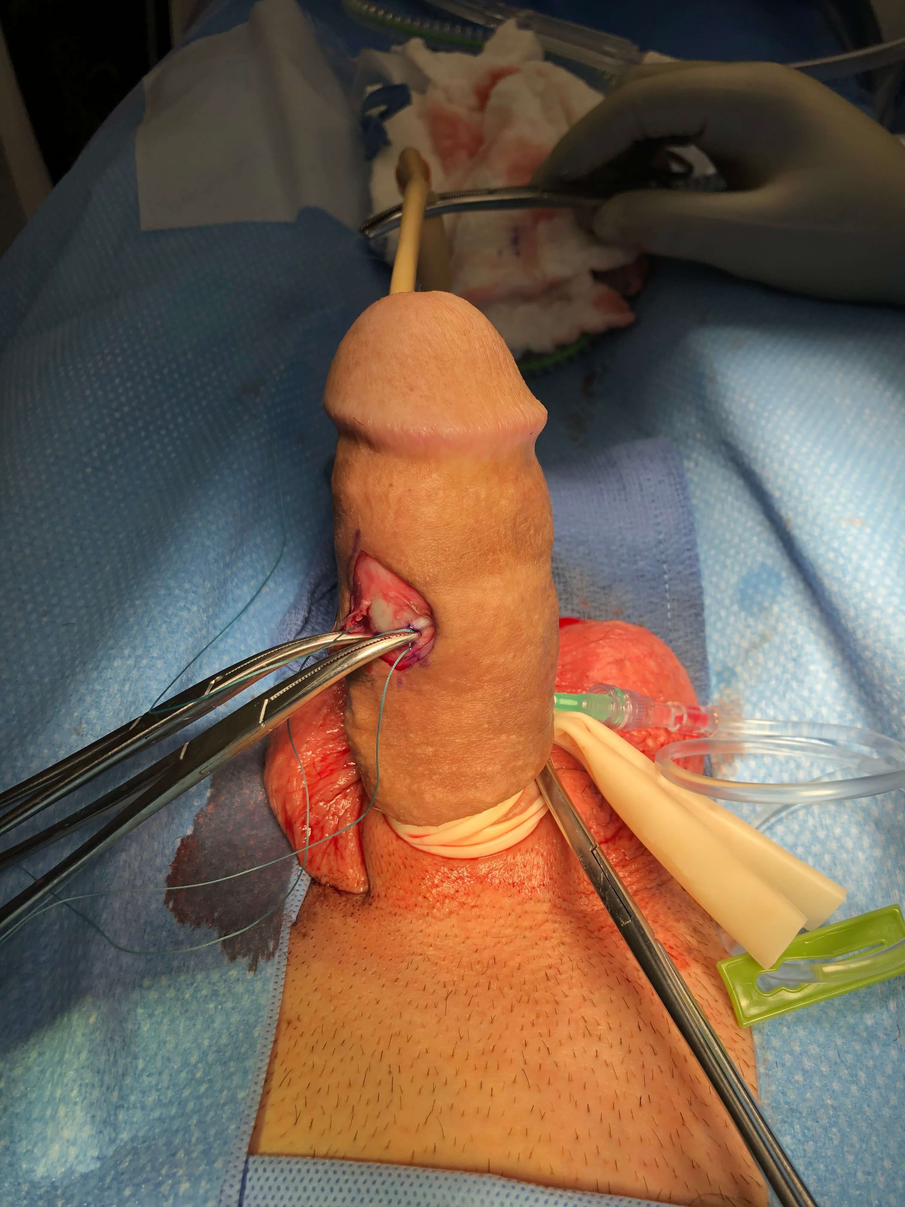 After Dot Plication Technique After