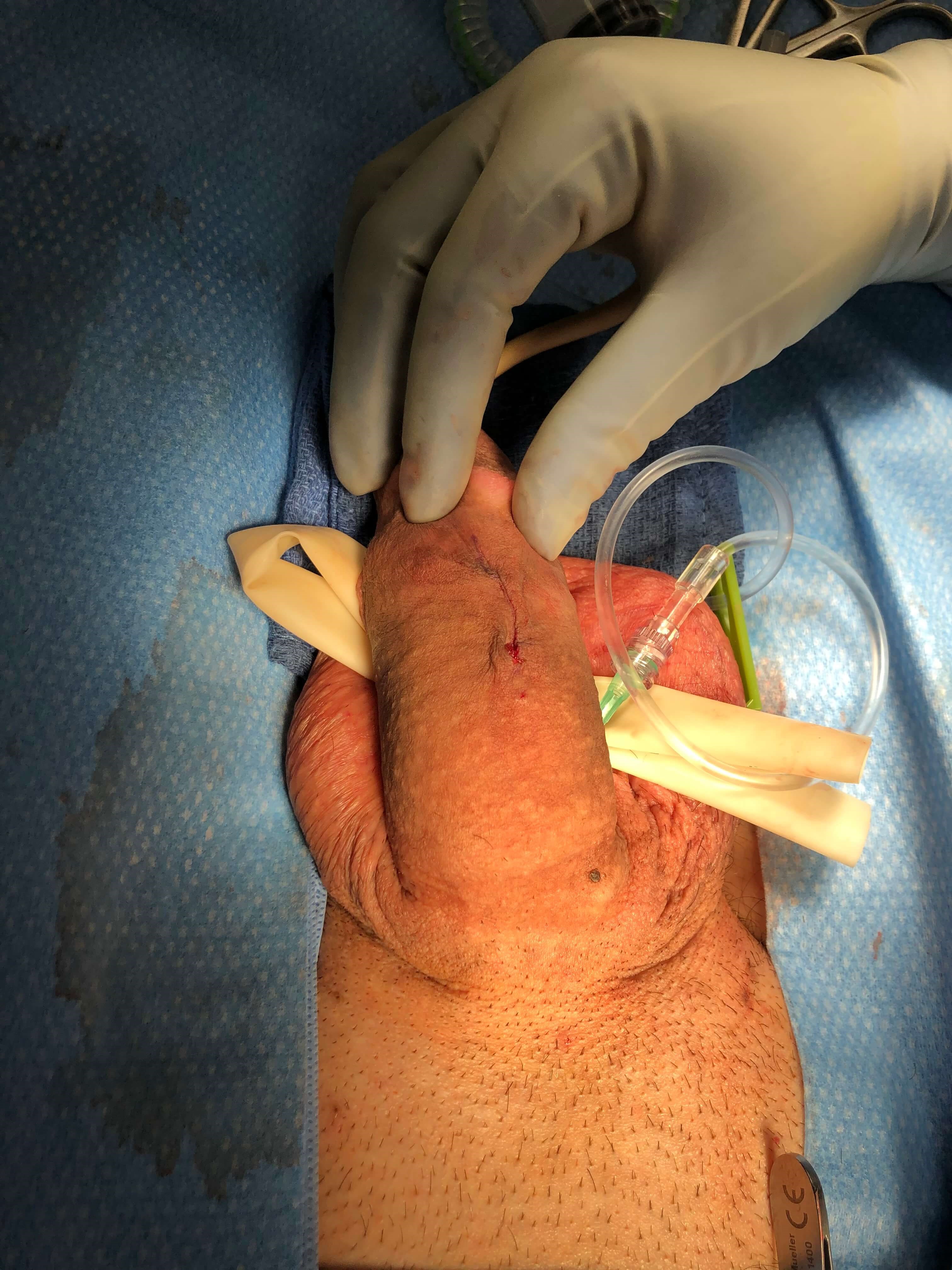 After Dot Plication Technique After