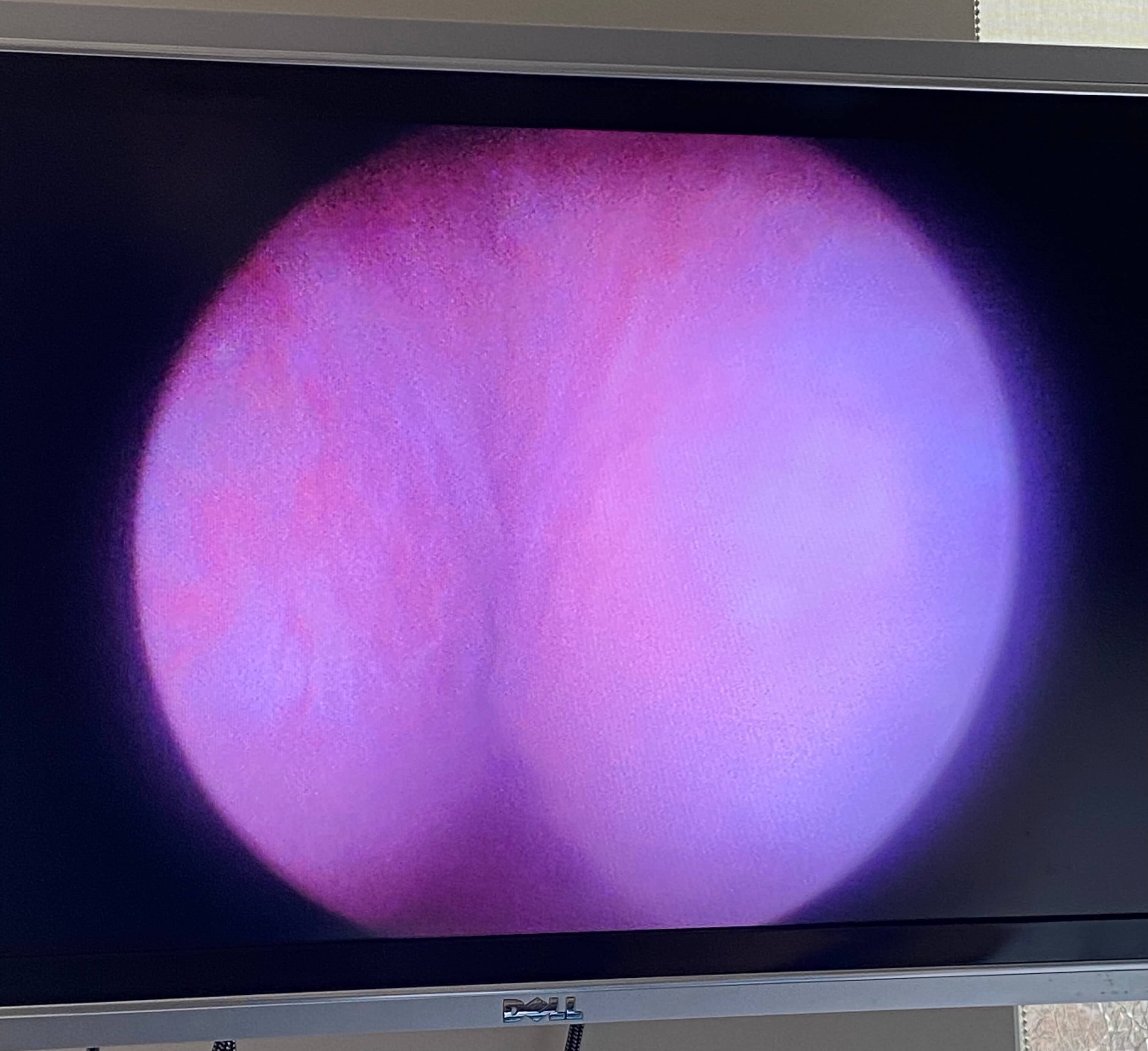 UroLift Before UroLift