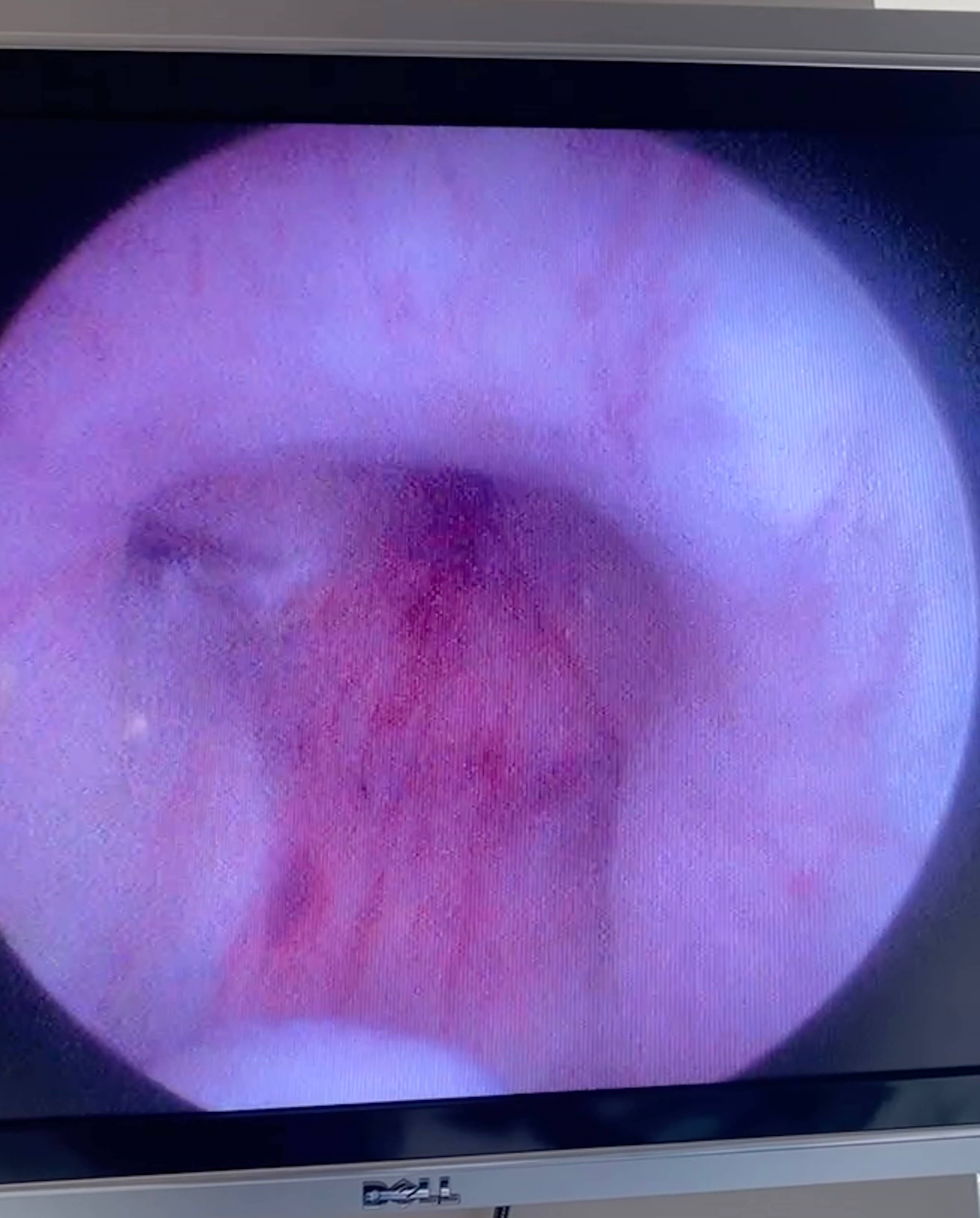 UroLift After UroLift