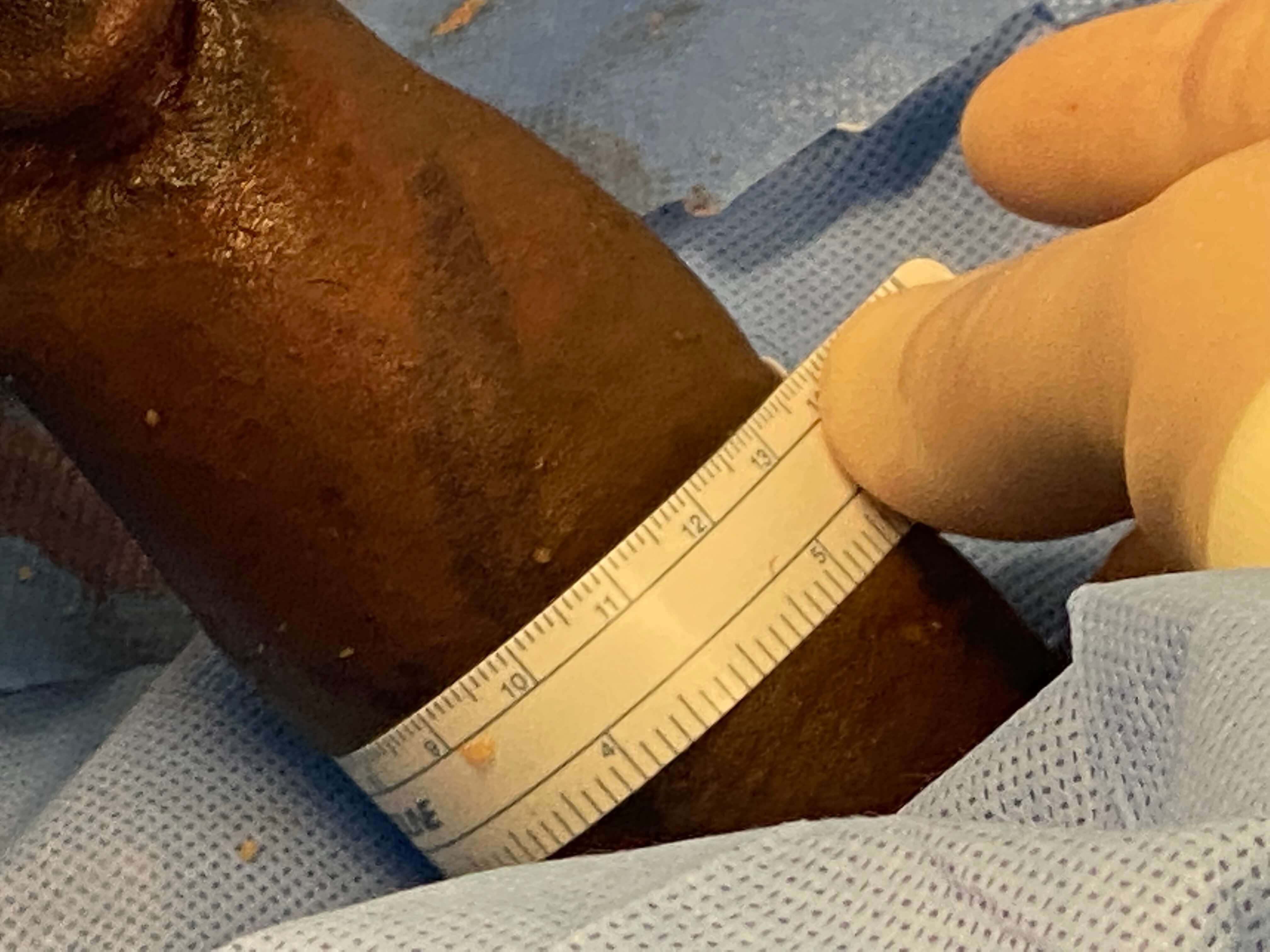 Before and After Fat Transfer After