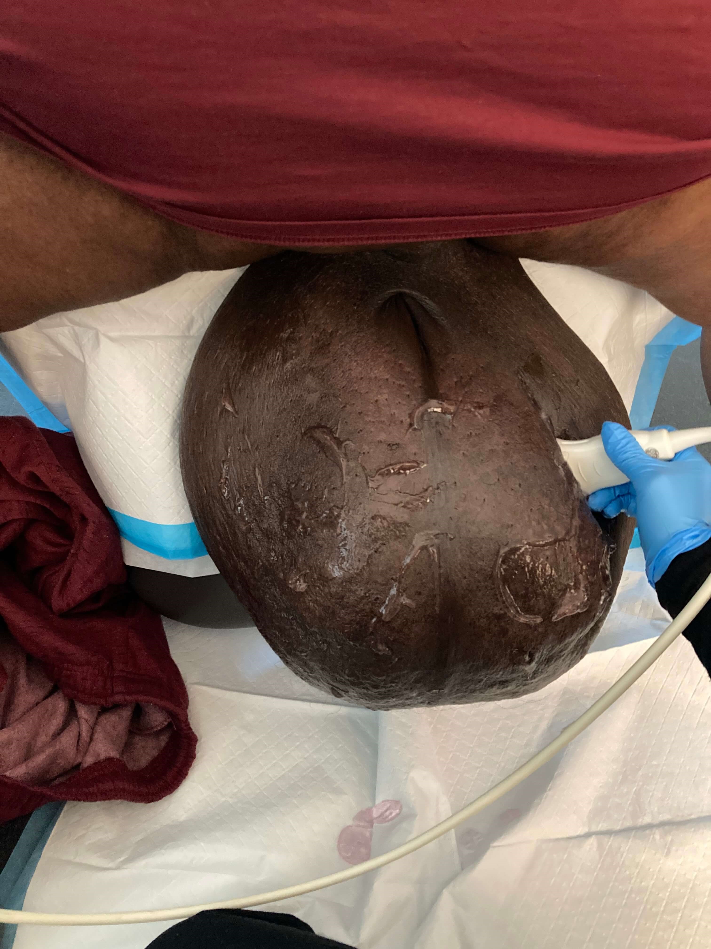 Scrotal Edema | Before&after Before