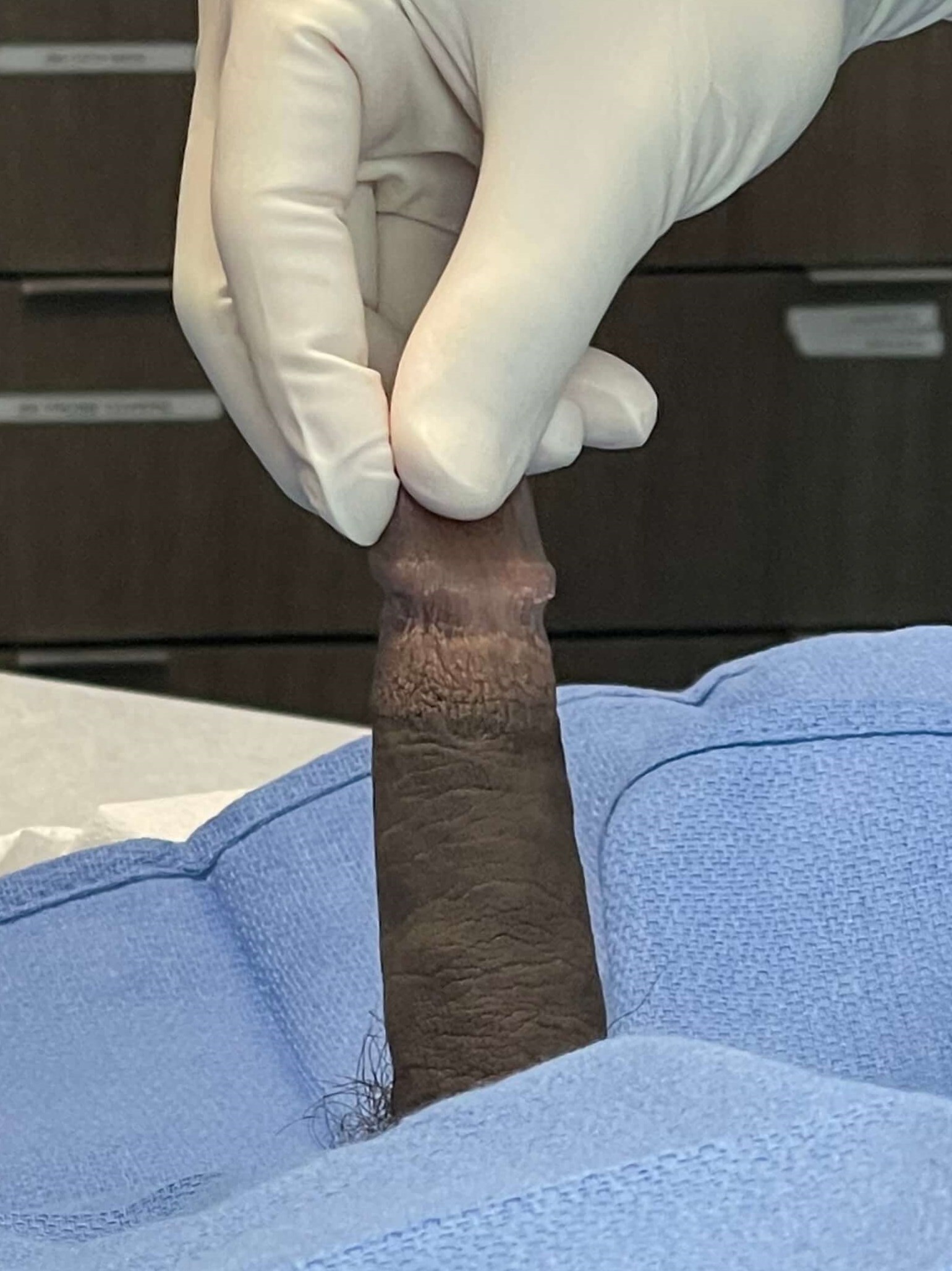 Penile Girth Enhancement 12cc Before