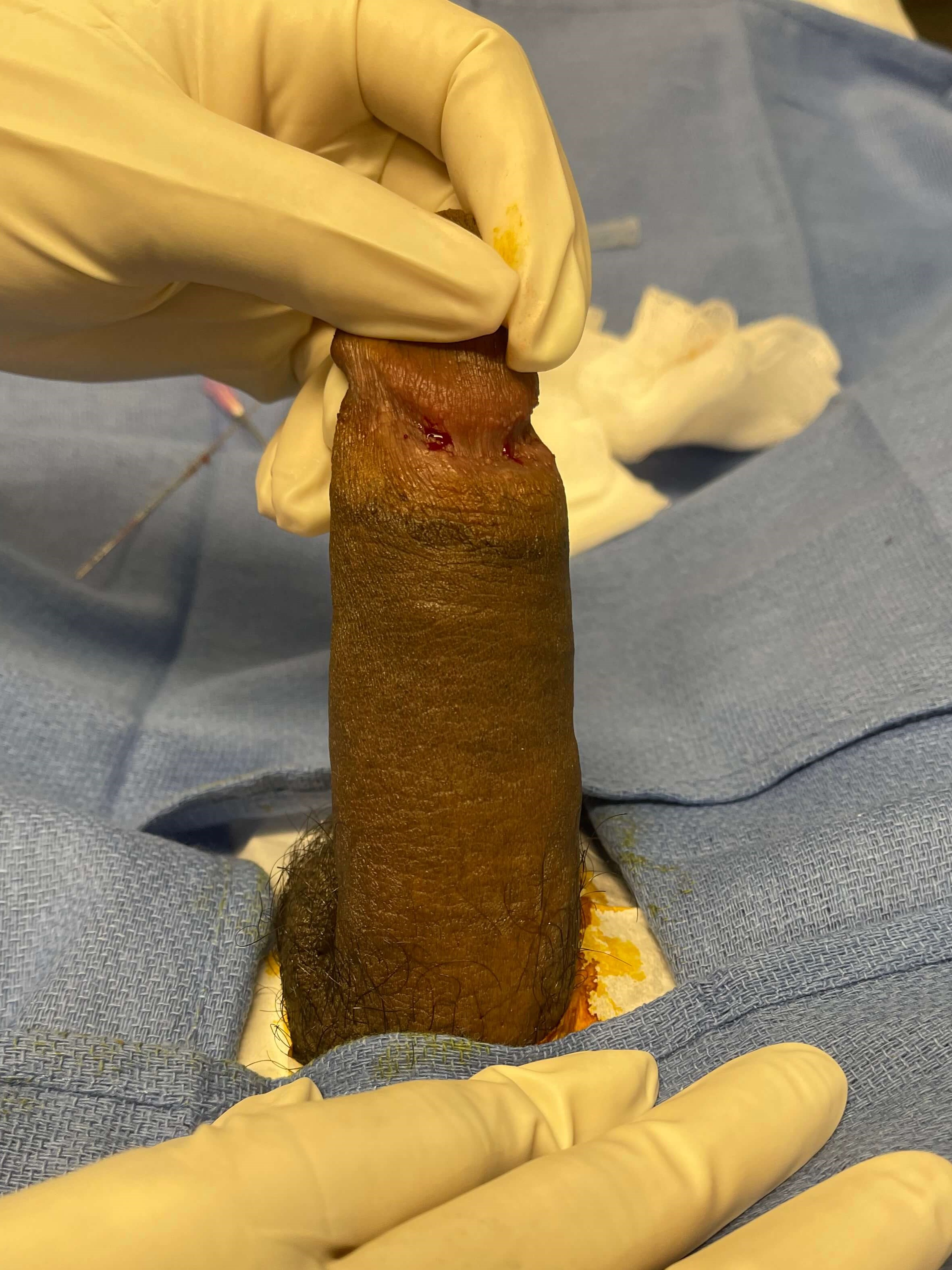 Penile Girth Enhancement 12cc After